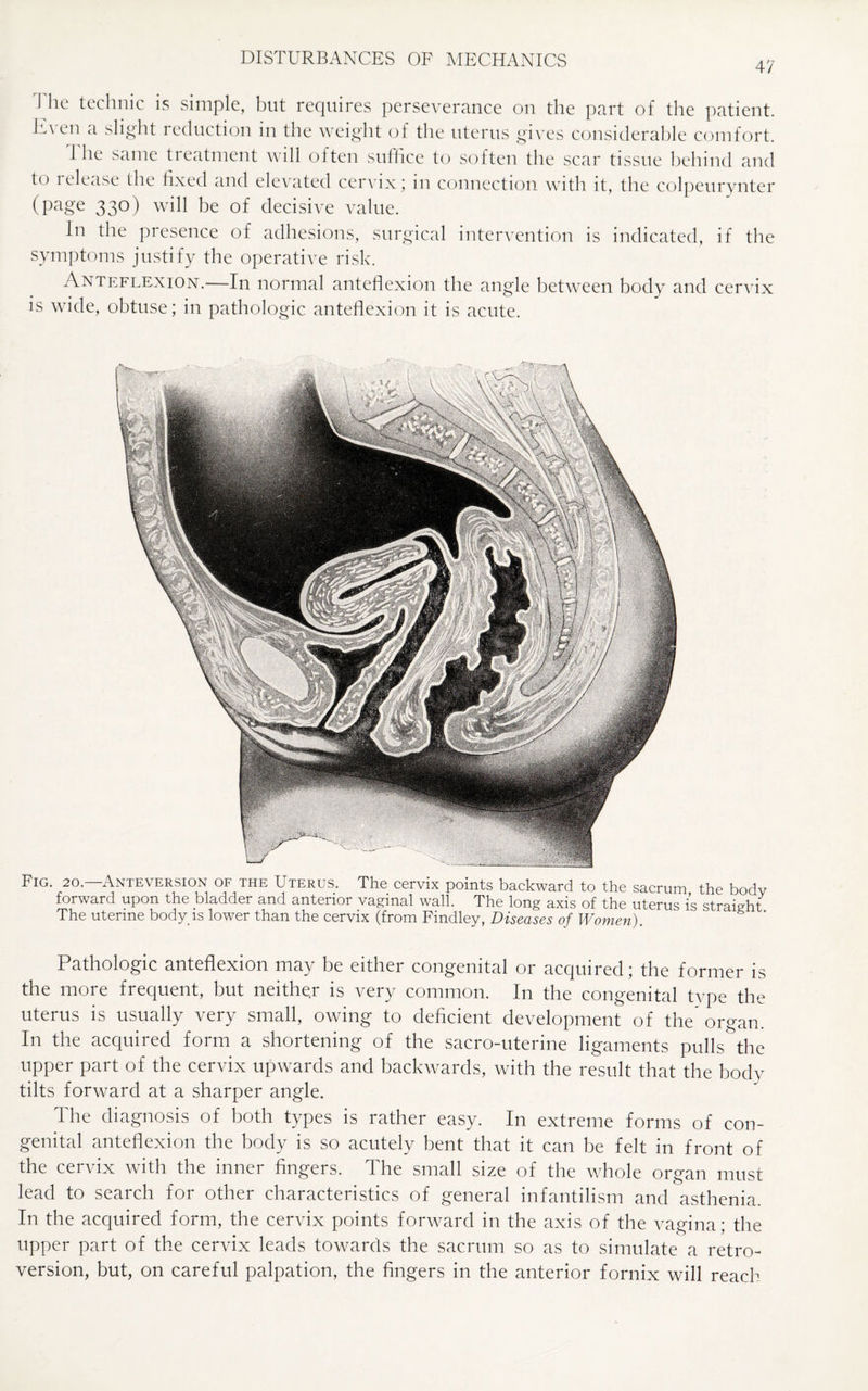 47 J he technic is simple, but requires perseverance on the part of the patient. L\en a slight reduction in the weight of the uterus gives considerable comfort. The same treatment will often suffice to soften the scar tissue behind and to 1 elease the fixed and elevated cervix j in connection with it, the colpeurynter (page 330) will be of decisive value. In the presence of adhesions, surgical intervention is indicated, if the symptoms justify the operative risk. Anteflexion.—In normal anteflexion the angle between body and cervix is wide, obtuse; in pathologic anteflexion it is acute. Fig. 20.—Anteversion of the Uterus. The cervix points backward to the sacrum the body forward upon the bladder and anterior vaginal wall. The long axis of the uterus is straight The uterine body is lower than the cervix (from Findley, Diseases of Women). Pathologic anteflexion may be either congenital or acquired; the former is the more frequent, but neithe.r is very common. In the congenital type the uterus is usually very small, owing to deficient development of the'or°-an. In the acquired form a shortening of the sacro-uterine ligaments pulls the upper part of the cervix upwards and backwards, with the result that the body tilts forward at a sharper angle. The diagnosis of both types is rather easy. In extreme forms of con¬ genital anteflexion the body is so acutely bent that it can be felt in front of the cervix with the inner fingers. The small size of the whole organ must lead to search for other characteristics of general infantilism and asthenia. In the acquired form, the cervix points forward in the axis of the vagina; the upper part of the cervix leads towards the sacrum so as to simulate a retro¬ version, but, on careful palpation, the fingers in the anterior fornix will reach
