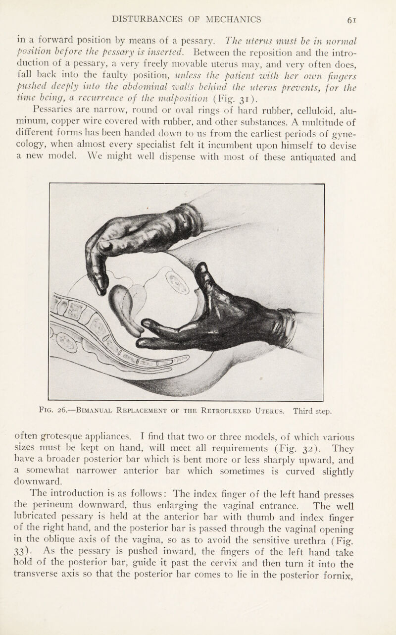 in a forward position by means of a pessary. The uterus must be in normal position before the pessary is inserted. Between the reposition and the intro¬ duction of a pessary, a very freely movable uterus may, and very often does, fall hack into the faulty position, unless the patient with her own fingers pushed deeply into the abdominal walls behind the uterus prevents, for the time being, a recurrence of the malposition (Fig. 31). Pessaries are narrow, round or oval rings of hard rubber, celluloid, alu¬ minum, copper wire covered with rubber, and other substances. A multitude of different forms has been handed down to us from the earliest periods of gyne- cology, when almost every specialist felt it incumbent upon himself to devise a new model. We might well dispense with most of these antiquated and Fig. 26.—Bimanual Replacement of the Retroflexed Uterus. Third step. often grotesque appliances. I find that two or three models, of which various sizes must be kept on hand, will meet all requirements (Fig. 32). They have a broader posterior bar which is bent more or less sharply upward, and a somewhat narrower anterior bar which sometimes is curved slightly downward. The introduction is as follows: The index finger of the left hand presses the perineum downward, thus enlarging the vaginal entrance. The well lubricated pessary is held at the anterior bar with thumb and index finger of the right hand, and the posterior bar is passed through the vaginal opening in the oblique axis of the vagina, so as to avoid the sensitive urethra (Fig. 33). As the pessary is pushed inward, the fingers of the left hand take hold of the posterior bar, guide it past the cervix and then turn it into the transverse axis so that the posterior bar comes to lie in the posterior fornix,