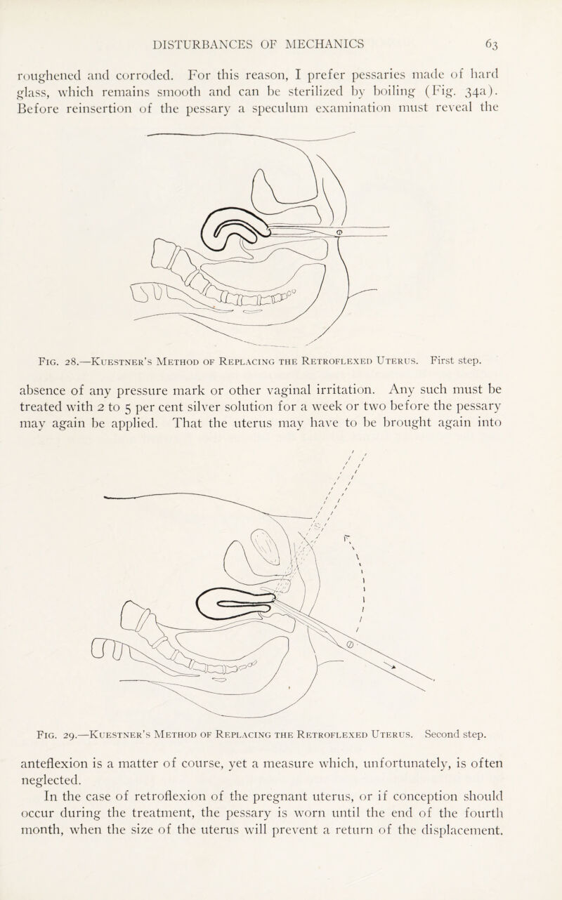 roughened and corroded. For this reason, I prefer pessaries made of hard glass, which remains smooth and can be sterilized by boiling (big. 34a). Before reinsertion of the pessary a speculum examination must reveal the Fig. 28.—Kuestner’s Method of Replacing the Retroflexed Uterus. First step. absence of any pressure mark or other vaginal irritation. Any such must be treated with 2 to 5 per cent silver solution for a week or two before the pessary may again be applied. That the uterus may have to be brought again into / / / / , / / / Fig. 29.—Kuestner’s Method of Replacing the Retroflexed Uterus. Second step. anteflexion is a matter of course, yet a measure which, unfortunately, is often neglected. In the case of retroflexion of the pregnant uterus, or if conception should occur during the treatment, the pessary is worn until the end of the fourth month, when the size of the uterus will prevent a return of the displacement.