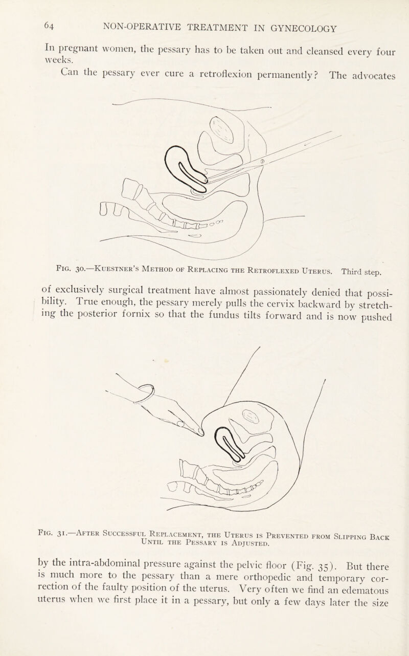 In pregnant women, the pessary has to be taken out and cleansed every four weeks. Can the pessary ever cure a retroflexion permanently? The advocates Fig. 30. Kuestner’s Method of Replacing the Retroflexed Uterus. Third step. of exclusively surgical treatment have almost passionately denied that possi¬ bility. True enough, the pessary merely pulls the cervix backward by stretch¬ ing the posterior fornix so that the fundus tilts forward and is now pushed Fig. 31. After Successful Replacement, the Uterus is Prevented from Slipping Back Until the Pessary is Adjusted. by the intra-abdominal pressure against the pelvic floor (Fig. 35). But there is much moie to the pessary than a mere orthopedic and temporary cor¬ rection of the faulty position of the uterus. Very often we find an edematous uterus when we first place it in a pessary, but only a few days later the size