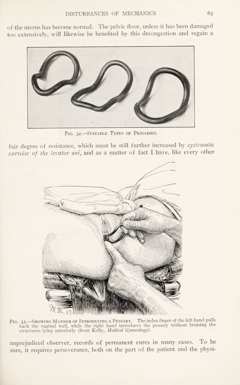 of the uterus has become normal. The pelvic floor, unless it has been damaged too extensively, will likewise be benefited by this decongestion and regain a Fig. 32.—Suitable Types of Pessaries. fair degree of resistance, which must be still further increased by systematic exercise of the levator ani, and as a matter of fact I have, like every other Fig. 33.—Showing Manner of Introducing a Pessary. The index finger of the left hand pulls back the vaginal wall, while the right hand introduces the pessary without bruising the structures lying anteriorly (from Kelly, Medical Gynecology). unprejudiced observer, records of permanent cures in many cases. To be sure, it requires perseverance, both on the part of the patient and the physi-