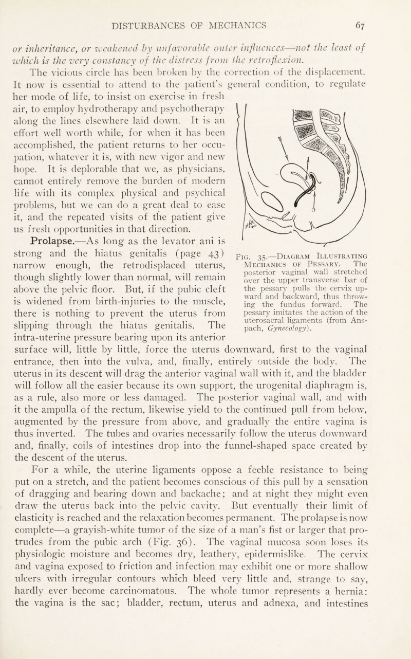 or inheritance, or weakened by unfavorable outer influences—not the least of which is the very constancy of the distress from the retroflexion. The vicious circle has been broken by the correction of the displacement. It now is essential to attend to the patient’s general condition, to regulate her mode of life, to insist on exercise in fresh air, to employ hydrotherapy and psychotherapy along the lines elsewhere laid down. It is an effort well worth while, for when it has been accomplished, the patient returns to her occu¬ pation, whatever it is, with new vigor and new hope. It is deplorable that we, as physicians, cannot entirely remove the burden of modern life with its complex physical and psychical problems, but we can do a great deal to ease it, and the repeated visits of the patient give us fresh opportunities in that direction. Prolapse.—As long as the levator ani is strong and the hiatus genitalis (page 43) narrow enough, the retrodisplaced uterus, though slightly lower than normal, will remain above the pelvic floor. But, if the pubic cleft is widened from birth-injuries to the muscle, there is nothing to prevent the uterus from slipping through the hiatus genitalis. The intra-uterine pressure bearing upon its anterior surface will, little by little, force the uterus downward, first to the vaginal entrance, then into the vulva, and, finally, entirely outside the body. The uterus in its descent will drag the anterior vaginal wall with it, and the bladder will follow all the easier because its own support, the urogenital diaphragm is, as a rule, also more or less damaged. The posterior vaginal wall, and with it the ampulla of the rectum, likewise yield to the continued pull from below, augmented by the pressure from above, and gradually the entire vagina is thus inverted. The tubes and ovaries necessarily follow the uterus downward and, finally, coils of intestines drop into the funnel-shaped space created by the descent of the uterus. For a while, the uterine ligaments oppose a feeble resistance to being put on a stretch, and the patient becomes conscious of this pull by a sensation of dragging and bearing down and backache; and at night they might even draw the uterus back into the pelvic cavity. But eventually their limit of elasticity is reached and the relaxation becomes permanent. The prolapse is now complete—a grayish-white tumor of the size of a man’s fist or larger that pro¬ trudes from the pubic arch (Fig. 36). The vaginal mucosa soon loses its physiologic moisture and becomes dry, leathery, epidermislike. The cervix and vagina exposed to friction and infection may exhibit one or more shallow ulcers with irregular contours which bleed very little and, strange to sav, hardly ever become carcinomatous. The whole tumor represents a hernia: the vagina is the sac; bladder, rectum, uterus and adnexa, and intestines posterior vaginal wall stretched over the upper transverse bar of the pessary pulls the cervix up¬ ward and backward, thus throw¬ ing the fundus forward. The pessary imitates the action of the uterosacral ligaments (from Ans- pach, Gynecology).