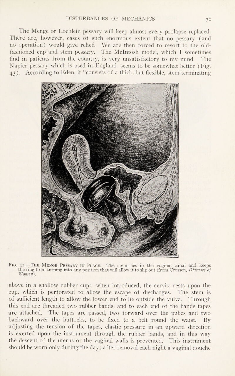 The Menge or Loehlein pessary will keep almost every prolapse replaced. There are, however, cases of such enormous extent that no pessary (and no operation) would give relief. We are then forced to resort to the old- fashioned cup and stem pessary. The McIntosh model, which I sometimes find in patients from the country, is very unsatisfactory to my mind. The Napier pessary which is used in England seems to be somewhat better (Fig. 43). According to Eden, it “consists of a thick, but flexible, stem terminating Fig. 41.—The Menge Pessary in Place. The stem lies in the vaginal canal and keeps the ring from turning into any position that will allow it to slip out (from Crossen, Diseases of Women). above in a shallow rubber cup; when introduced, the cervix rests upon the cup, which is perforated to allow the escape of discharges. The stem is of sufficient length to allow the lower end to lie outside the vulva. Through this end are threaded two rubber bands, and to each end of the bands tapes are attached. The tapes are passed, two forward over the pubes and two backward over the buttocks, to be fixed to a belt round the waist. By adjusting the tension of the tapes, elastic pressure in an upward direction is exerted upon the instrument through the rubber bands, and in this way the descent of the uterus or the vaginal walls is prevented. This instrument should be worn only during the day; after removal each night a vaginal douche