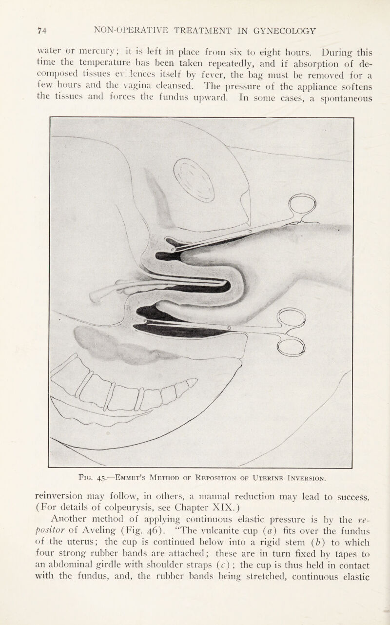 water or mercury; it is left in place from six to eight hours. During this time the temperature has been taken repeatedly, and if absorption of de¬ composed tissues evidences itself by fever, the bag must be removed for a few hours and the vagina cleansed. The pressure of the appliance softens the tissues and forces the fundus upward. In some cases, a spontaneous Fig. 45.—Emmet’s Method of Reposition of Uterine Inversion. reinversion may follow, in others, a manual reduction may lead to success. (For details of colpeurysis, see Chapter XIX.) Another method of applying continuous elastic pressure is by the re- positor of Aveling (Fig. 46). “The vulcanite cup (a) fits over the fundus of the uterus; the cup is continued below into a rigid stem (b) to which four strong rubber bands are attached; these are in turn fixed by tapes to an abdominal girdle with shoulder straps (c) ; the cup is thus held in contact with the fundus, and, the rubber bands being stretched, continuous elastic