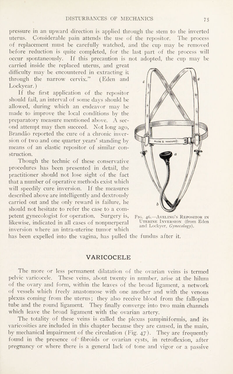 pressure in an upward direction is applied through the stem to the inverted uterus. Considerable pain attends the use of the repositor. The process of replacement must be carefully watched, and the cup may be removed before reduction is quite completed, for the last part of the process will occur spontaneously. If this precaution is not adopted, the cup may be carried inside the replaced uterus, and great difficulty may be encountered in extracting it through the narrow cervix.” (Eden and Lockyear.) If the first application of the repositor should fail, an interval of some days should be allowed, during which an endeavor may be made to improve the local conditions by the preparatory measure mentioned above. A sec¬ ond attempt may then succeed. Not long ago, Brandao reported the cure of a chronic inver¬ sion of two and one quarter years’ standing by means of an elastic repositor of similar con¬ struction. Though the technic of these conservative procedures has been presented in detail, the practitioner should not lose sight of the fact that a number of operative methods exist which will speedily cure inversion. If the measures described above are intelligently and dextrously carried out and the only reward is failure, he should not hesitate to refer the case to a com¬ petent gynecologist for operation. Surgery is, likewise, indicated in all cases of nonpuerperal inversion where an intra-uterine tumor which has been expelled into the vagina, has pulled the fundus after it. Fig. 46.—Aveling’s Repositor in Uterine Inversion (from Eden and Lockyer, Gynecology). VARICOCELE The more or less permanent dilatation of the ovarian veins is termed pelvic varicocele. These veins, about twenty in number, arise at the hilum of the ovary and form, within the leaves of the broad ligament, a network of vessels which freely anastomose with one another and with the venous plexus coming from the uterus; they also receive blood from the fallopian tube and the round ligament. They finally converge into two main channels which leave the broad ligament with the ovarian artery. The totality of these veins is called the plexus pampiniformis, and its varicosities are included in this chapter because they are caused, in the main, by mechanical impairment of the circulation (Fig. 47). They are frequently found in the presence of fibroids or ovarian cysts, in retroflexion, after pregnancy or where there is a general lack of tone and vigor or a passive