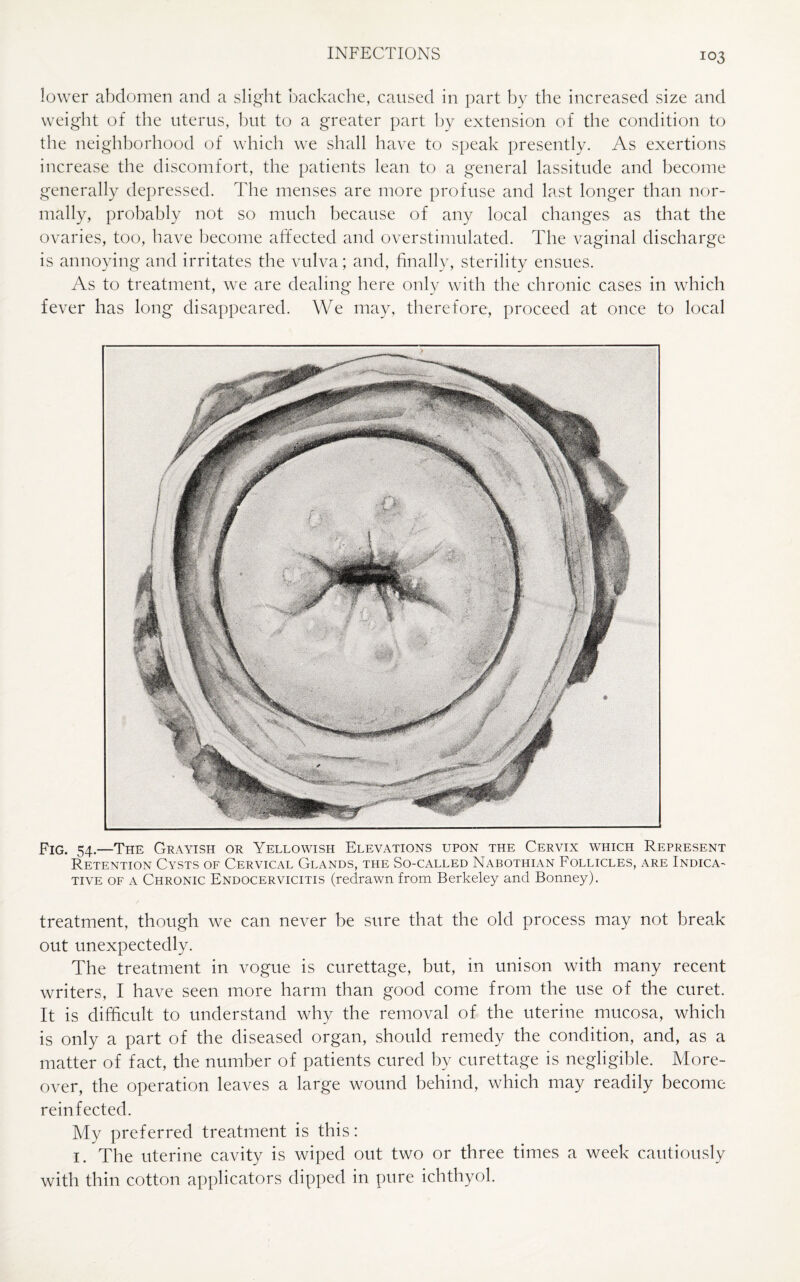 lower abdomen and a slight backache, caused in part by the increased size and weight of the uterus, but to a greater part by extension of the condition to the neighborhood of which we shall have to speak presently. As exertions increase the discomfort, the patients lean to a general lassitude and become generally depressed. The menses are more profuse and last longer than nor¬ mally, probably not so much because of any local changes as that the ovaries, too, have become affected and overstimulated. The vaginal discharge is annoying and irritates the vulva; and, finally, sterility ensues. As to treatment, we are dealing here only with the chronic cases in which fever has long disappeared. We may, therefore, proceed at once to local Fig. 54.—The Grayish or Yellowish Elevations upon the Cervix which Represent Retention Cysts of Cervical Glands, the So-called Nabothian Follicles, are Indica^ tive of a Chronic Endocervicitis (redrawn from Berkeley and Bonney). treatment, though we can never be sure that the old process may not break out unexpectedly. The treatment in vogue is curettage, but, in unison with many recent writers, I have seen more harm than good come from the use of the curet. It is difficult to understand why the removal of the uterine mucosa, which is only a part of the diseased organ, should remedy the condition, and, as a matter of fact, the number of patients cured by curettage is negligible. More¬ over, the operation leaves a large wound behind, which may readily become reinfected. My preferred treatment is this: 1. The uterine cavity is wiped out two or three times a week cautiously with thin cotton applicators dipped in pure ichthyol.