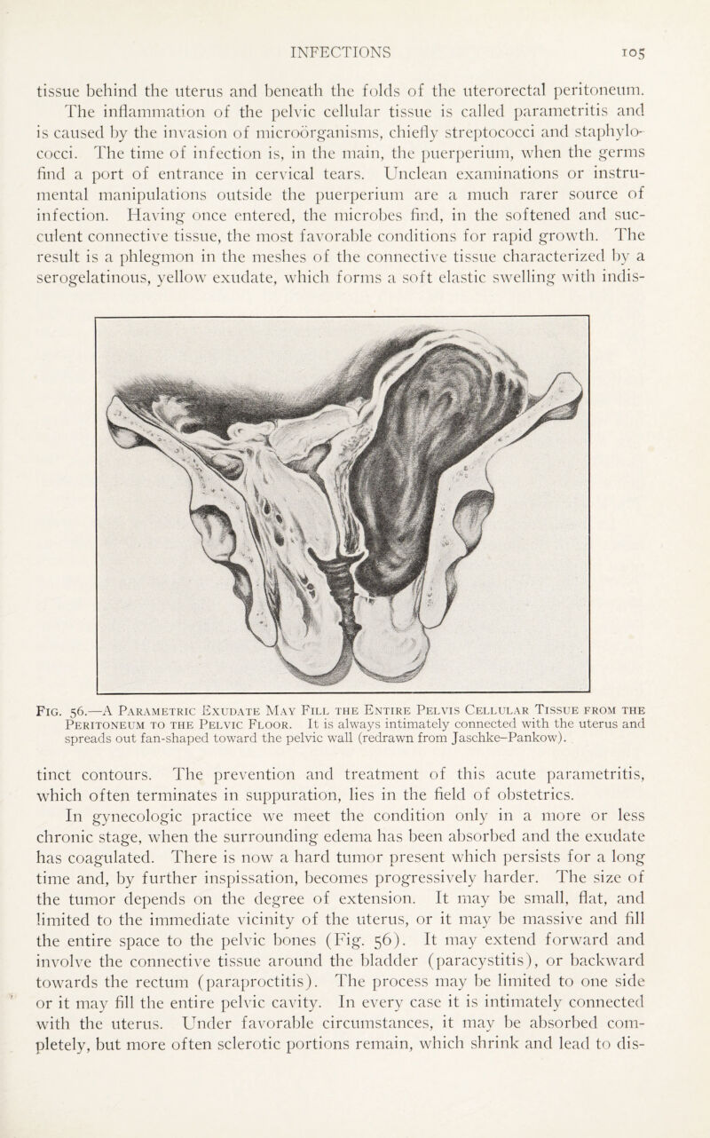tissue behind the uterus and beneath the folds of the uterorectal peritoneum. The inflammation of the pelvic cellular tissue is called parametritis and is caused by the invasion of microorganisms, chiefly streptococci and staphylo¬ cocci. The time of infection is, in the main, the puerperium, when the germs find a port of entrance in cervical tears. Unclean examinations or instru¬ mental manipulations outside the puerperium are a much rarer source of infection. Having once entered, the microbes find, in the softened and suc¬ culent connective tissue, the most favorable conditions for rapid growth. The result is a phlegmon in the meshes of the connective tissue characterized by a serogelatinous, yellow exudate, which forms a soft elastic swelling with indis- Fig. 56.—A Parametric Exudate May Fill the Entire Pelvis Cellular Tissue from the Peritoneum to the Pelvic Floor. It is always intimately connected with the uterus and spreads out fan-shaped toward the pelvic wall (redrawn from Jaschke-Pankow). tinct contours. The prevention and treatment of this acute parametritis, which often terminates in suppuration, lies in the field of obstetrics. In gynecologic practice we meet the condition only in a more or less chronic stage, when the surrounding edema has been absorbed and the exudate has coagulated. There is now a hard tumor present which persists for a long time and, by further inspissation, becomes progressively harder. The size of the tumor depends on the degree of extension. It may be small, flat, and limited to the immediate vicinity of the uterus, or it may be massive and fill the entire space to the pelvic bones (Fig. 56). It may extend forward and involve the connective tissue around the bladder (paracystitis), or backward towards the rectum (paraproctitis). The process may be limited to one side or it may fill the entire pelvic cavity. In every case it is intimately connected with the uterus. Under favorable circumstances, it may be absorbed com¬ pletely, but more often sclerotic portions remain, which shrink and lead to dis-