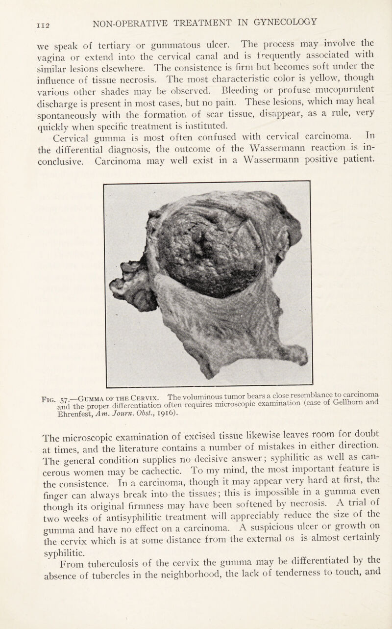 we speak of tertiary or gummatous ulcer. The process may involve the vagina or extend into the cervical canal and is frequently associated with similar lesions elsewhere. The consistence is firm but becomes soft under the influence of tissue necrosis. The most characteristic color is yellow, though various other shades may be observed. Bleeding or profuse mucopurulent discharge is present in most cases, but no pain. I hese lesions, which may heal spontaneously with the formation of scar tissue, disappear, as a mle, very quickly when specific treatment is instituted. Cervical gumma is most often confused with cervical carcinoma. In the differential diagnosis, the outcome of the Wassermann reaction is in¬ conclusive. Carcinoma may well exist in a Wassermann positive patient. pIG cn —Gumma of the Cervix. The voluminous tumor bears a close resemblance to carcinoma * and the proper differentiation often requires microscopic examination (case of Gellhorn and Ehrenfest, Am. Journ. Obst., 1916). The microscopic examination of excised tissue likewise leaves loom for doubt at times, and the literature contains a number of mistakes in either direction. The general condition supplies no decisive answer; syphilitic as well as can¬ cerous women may be cachectic. To my mind, the most important feature is the consistence. In a carcinoma, though it may appear very hard at first, the finger can always break into the tissues; this is impossible in a gumma even though its original firmness may have been softened by necrosis. A trial of two weeks of antisyphilitic treatment will appreciably reduce the size of the gumma and have no effect on a carcinoma. A suspicious ulcer or growth on the cervix which is at some distance from the external os is almost certainly syphilitic. . From tuberculosis of the cervix the gumma may be differentiated by the absence of tubercles in the neighborhood, the lack of tenderness to touch, and