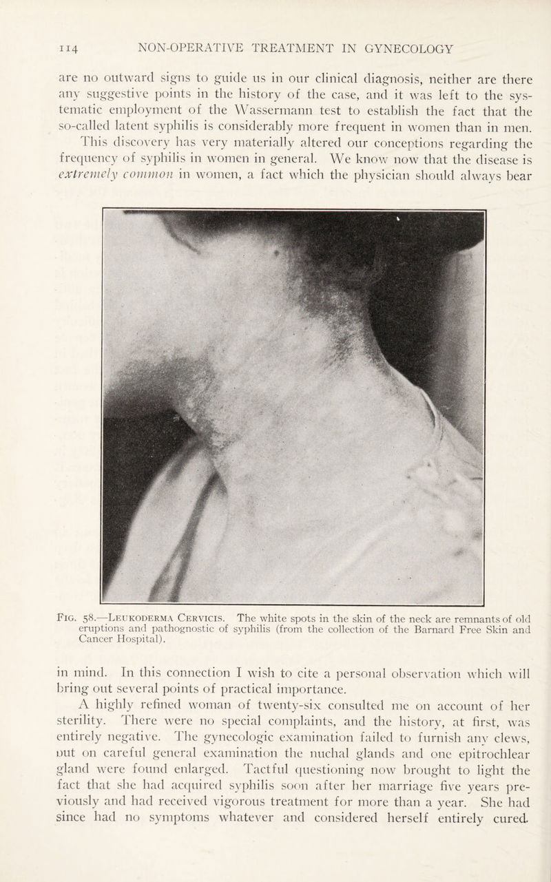 are no outward signs to guide us in our clinical diagnosis, neither are there any suggestive points in the history of the case, and it was left to the sys¬ tematic employment of the Wassermann test to establish the fact that the so-called latent syphilis is considerably more frequent in women than in men. This discovery has very materially altered our conceptions regarding the frequency of syphilis in women in general. We know now that the disease is extremely common in women, a fact which the physician should always bear Fig. 58.-—Leukoderma Cervicis. The white spots in the skin of the neck are remnants of old eruptions and pathognostic of syphilis (from the collection of the Barnard Free Skin and Cancer Hospital). in mind. In this connection I wish to cite a personal observation which will bring out several points of practical importance. A highly refined woman of twenty-six consulted me on account of her sterility. There were no special complaints, and the history, at first, was entirely negative. The gynecologic examination failed to furnish anv clews, out on careful general examination the nuchal glands and one epitrochlear gland were found enlarged. Tactful questioning now brought to light the fact that she had acquired syphilis soon after her marriage five years pre¬ viously and had received vigorous treatment for more than a year. She had since had no symptoms whatever and considered herself entirely cured.
