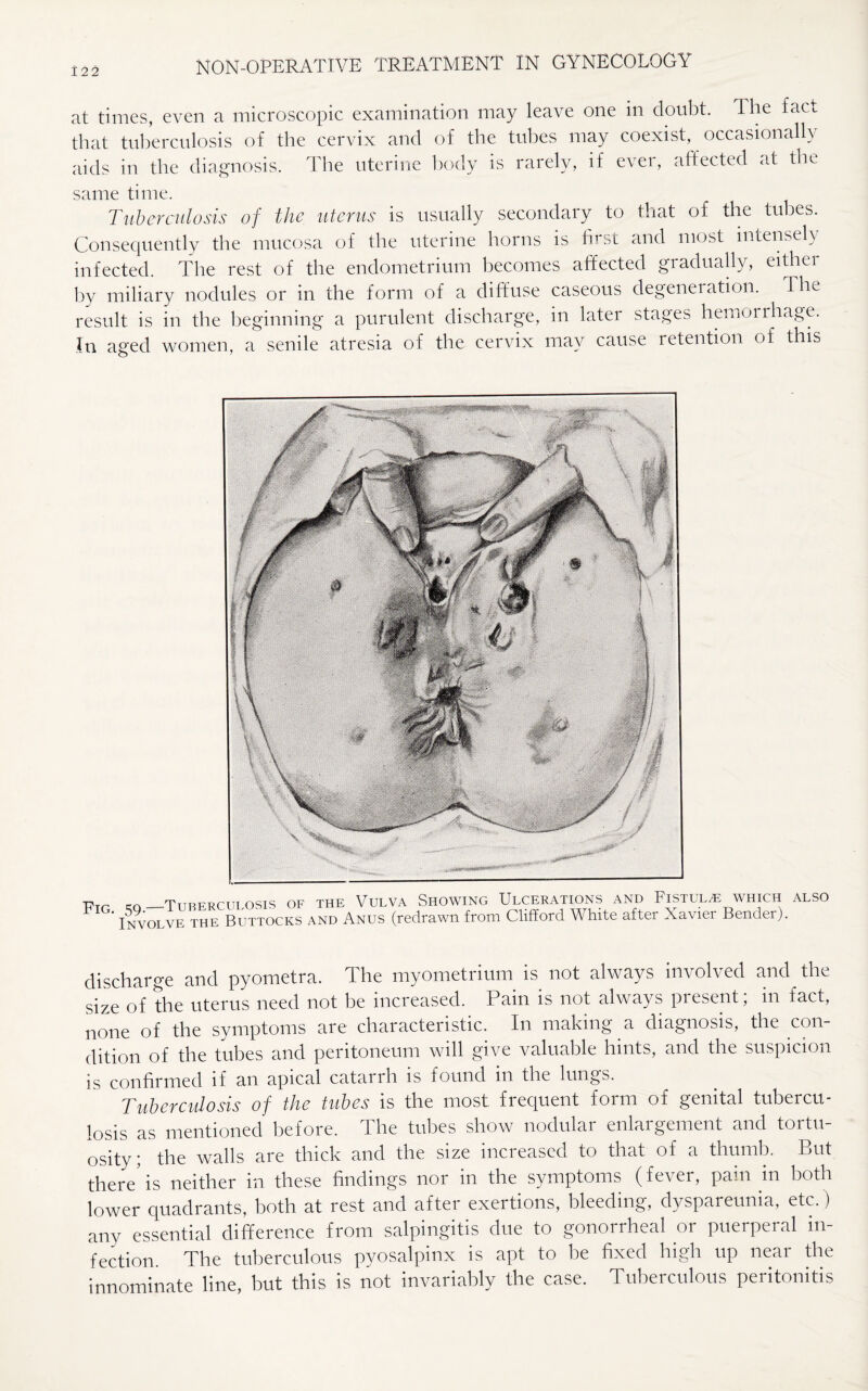 122 at times, even a microscopic examination may leave one in doubt. The fact that tuberculosis of the cervix and of the tubes may coexist, occasionally aids in the diagnosis. The uterine body is rarely, if ever, affected at the same time. Tuberculosis of the uterus is usually secondary to that of the tubes. Consequently the mucosa of the uterine horns is first and most intensely infected. The rest of the endometrium becomes affected gradually, either by miliary nodules or in the form of a diffuse caseous degeneration. The result is in the beginning a purulent discharge, in later stages hemoirhage. In aged women, a senile atresia of the cervix may cause retention of this Fig. r0 —Tuberculosis of the Vulva Showing Ulcerations and Fistula which also Involve the Buttocks and Anus (redrawn from Clifford White after Xavier Bender). discharge and pyometra. The myometrium is not always involved and the size of the uterus need not be increased. Pain is not always present; in fact, none of the symptoms are characteristic. In making a diagnosis, the con¬ dition of the tubes and peritoneum will give valuable hints, and the suspicion is confirmed if an apical catarrh is found in the lungs. Tuberculosis of the tubes is the most frequent form of genital tubercu¬ losis as mentioned before. The tubes show nodular enlargement and tortu¬ osity; the walls are thick and the size increased to that of a thumb. But there' is neither in these findings nor in the symptoms (fever, pain in both lower quadrants, both at rest and after exertions, bleeding, dyspareunia, etc.) any essential difference from salpingitis due to gonorrheal or puerperal in¬ fection The tuberculous pyosalpinx is apt to be fixed high up near the innominate line, but this is not invariably the case. Tuberculous peritonitis