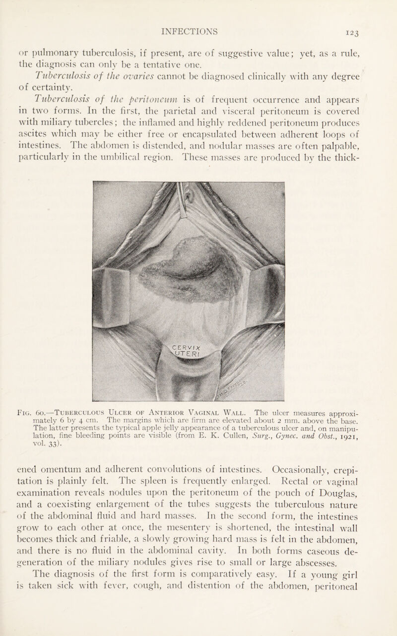 or pulmonary tuberculosis, if present, are of suggestive value; yet, as a rule, the diagnosis can only be a tentative one. Tuberculosis of the ovaries cannot be diagnosed clinically with any degree of certainty. Tuberculosis of the peritoneum is of frequent occurrence and appears in two forms. In the first, the parietal and visceral peritoneum is covered with miliary tubercles ; the inflamed and highly reddened peritoneum produces ascites which may be either free or encapsulated between adherent loops of intestines. The abdomen is distended, and nodular masses are often palpable, particularly in the umbilical region. These masses are produced by the thick- Fig. 6b.—Tuberculous Ulcer oe Anterior Vaginal Wall. The ulcer measures approxi¬ mately 6 by 4 cm. The margins which are firm are elevated about 2 mm. above the base. The latter presents the typical apple jelly appearance of a tuberculous ulcer and, on manipu¬ lation, fine bleeding points are visible (from E. K. Cullen, Surg., Gynec. and Obst., 1021 vol. 33). ened omentum and adherent convolutions of intestines. Occasionally, crepi¬ tation is plainly felt. The spleen is frequently enlarged. Rectal or vaginal examination reveals nodules upon the peritoneum of the pouch of Douglas, and a coexisting enlargement of the tubes suggests the tuberculous nature of the abdominal fluid and hard masses. In the second form, the intestines grow to each other at once, the mesentery is shortened, the intestinal wall becomes thick and friable, a slowly growing hard mass is felt in the abdomen, and there is no fluid in the abdominal cavity. In both forms caseous de¬ generation of the miliary nodules gives rise to small or large abscesses. The diagnosis of the first form is comparatively easy. If a young girl is taken sick with fever, cough, and distention of the abdomen, peritoneal