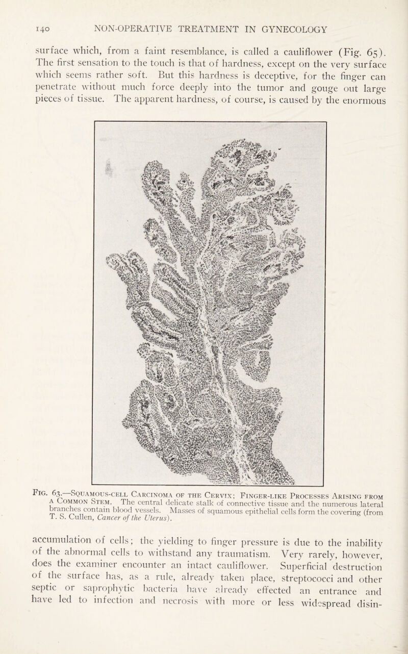 surface which, from a faint resemblance, is called a cauliflower (Fig. 65). 1 he first sensation to the touch is that of hardness, except on the very surface which seems rather soft. But this hardness is deceptive, for the finger can penetrate without much force deeply into the tumor and gouge out large pieces of tissue. The apparent hardness, of course, is caused by the enormous Fig. 63^ Squamous-cell Carcinoma of the Cervix; Finger-like Processes Arising from a Common Stem. The central delicate stalk of connective tissue and the numerous lateral branches contain blood vessels. Masses of squamous epithelial cells form the covering (from 1. S. Cullen, Cancer of the Uterus). accumulation of cells; the yielding to finger pressure is due to the inability of the abnormal cells to withstand any traumatism. Very rarely, however, does the examiner encounter an intact cauliflower. Superficial destruction of the surface has, as a rule, already taken place, streptococci and other septic or saprophytic bacteria have already effected an entrance and have led to infection and necrosis with more or less widespread disin-