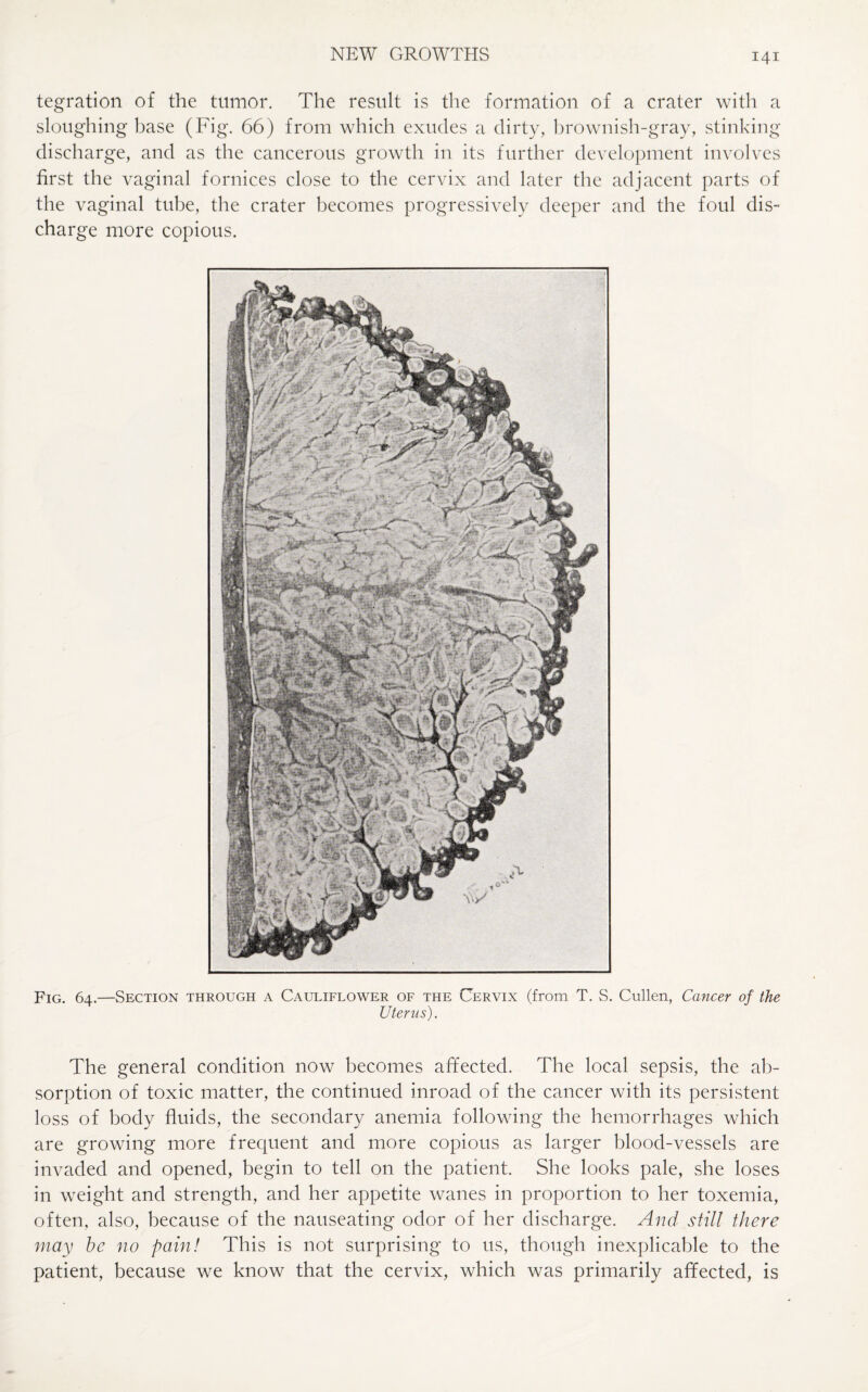 tegration of the tumor. The result is the formation of a crater with a sloughing base (Fig. 66) from which exudes a dirty, brownish-gray, stinking discharge, and as the cancerous growth in its further development involves first the vaginal fornices close to the cervix and later the adjacent parts of the vaginal tube, the crater becomes progressively deeper and the foul dis¬ charge more copious. Fig. 64.—Section through a Cauliflower of the Cervix (from T. S. Cullen, Cancer of the Uterus). The general condition now becomes affected. The local sepsis, the ab¬ sorption of toxic matter, the continued inroad of the cancer with its persistent loss of body fluids, the secondary anemia following the hemorrhages which are growing more frequent and more copious as larger blood-vessels are invaded and opened, begin to tell on the patient. She looks pale, she loses in weight and strength, and her appetite wanes in proportion to her toxemia, often, also, because of the nauseating odor of her discharge. And still there may he no pain! This is not surprising to us, though inexplicable to the patient, because we know that the cervix, which was primarily affected, is