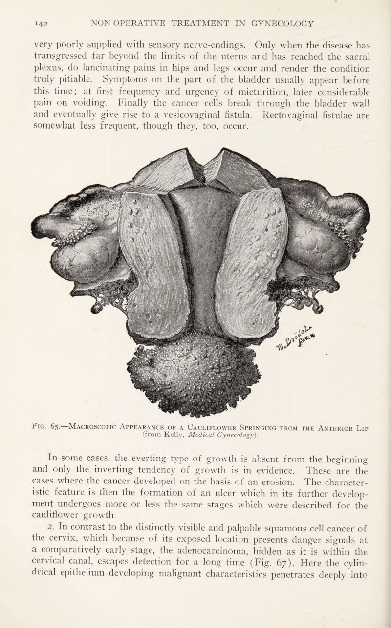 very poorly supplied with sensory nerve-endings. Only when the disease has transgressed far beyond the limits of the uterus and has reached the sacral plexus, do lancinating pains in hips and legs occur and render the condition truly pitiable. Symptoms on the part of the bladder usually appear before this time; at first frequency and urgency of micturition, later considerable pain on voiding. Finally the cancer cells break through the bladder wall and eventually give rise to a vesicovaginal fistula. Rectovaginal fistulae are somewhat less frequent, though they, too, occur. Fig. 65.—Macroscopic Appearance of a Cauliflower Springing from the Anterior Lip (from Kelly, Medical Gynecology). In some cases, the everting type of growth is absent from the beginning and only the inverting tendency of growth is in evidence. These are the cases where the cancer developed on the basis of an erosion. The character¬ istic feature is then the formation of an ulcer which in its further develop¬ ment undergoes more or less the same stages which were described for the cauliflower growth. 2. In contrast to the distinctly visible and palpable squamous cell cancer of the cervix, which because of its exposed location presents danger signals at a comparatively early stage, the adenocarcinoma, hidden as it is within the cervical canal, escapes detection for a long time (Fig. 67). Here the cylin¬ drical epithelium developing malignant characteristics penetrates deeply into