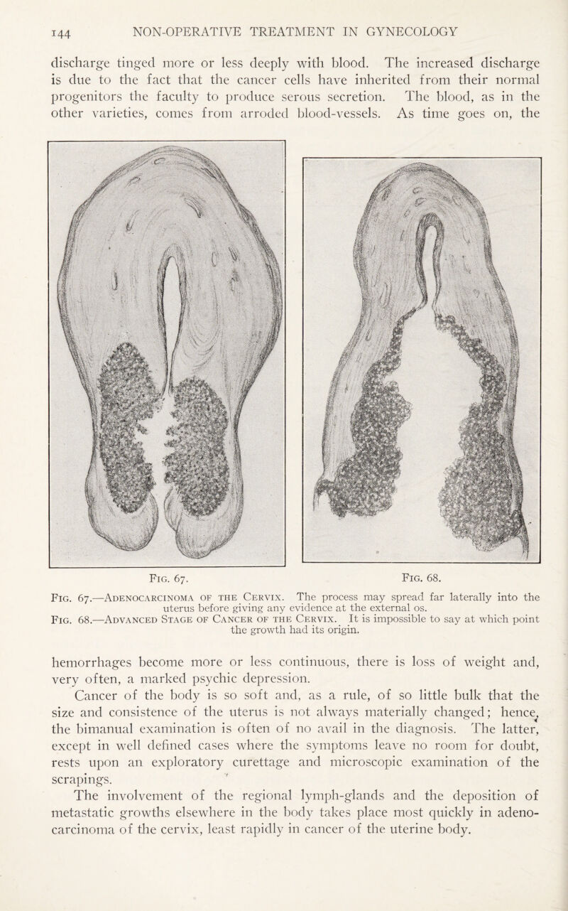 discharge tinged more or less deeply with blood. The increased discharge is due to the fact that the cancer cells have inherited from their normal progenitors the faculty to produce serous secretion. The blood, as in the other varieties, comes from arroded blood-vessels. As time goes on, the Fig. 67. Fig. 68. Fig. 67.—Adenocarcinoma of the Cervix. The process may spread far laterally into the uterus before giving any evidence at the external os. Fig. 68.—Advanced Stage of Cancer of the Cervix. It is impossible to say at which point the growth had its origin. hemorrhages become more or less continuous, there is loss of weight and, very often, a marked psychic depression. Cancer of the body is so soft and, as a rule, of so little bulk that the size and consistence of the uterus is not always materially changed; hence^ the bimanual examination is often of no avail in the diagnosis. The latter, except in well defined cases where the symptoms leave no room for doubt, rests upon an exploratory curettage and microscopic examination of the scrapings. The involvement of the regional lymph-glands and the deposition of metastatic growths elsewhere in the body takes place most quickly in adeno¬ carcinoma of the cervix, least rapidly in cancer of the uterine body.
