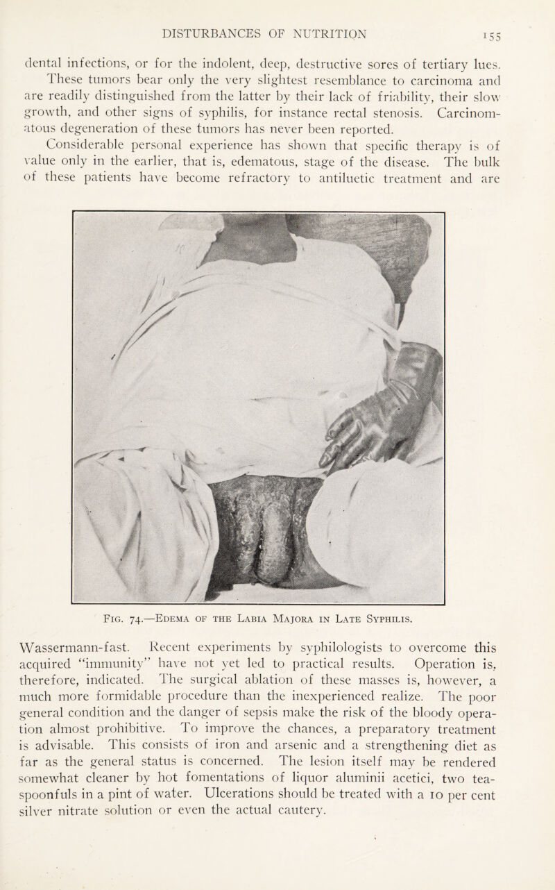 US5 dental infections, or for the indolent, deep, destructive sores of tertiary lues. 1 hese tumors bear only the very slightest resemblance to carcinoma and are readily distinguished from the latter by their lack of friability, their slow growth, and other signs of syphilis, for instance rectal stenosis. Carcinom¬ atous degeneration of these tumors has never been reported. Considerable personal experience has shown that specific therapy is of value only in the earlier, that is, edematous, stage of the disease. The bulk of these patients have become refractory to antiluetic treatment and are Fig. 74.—Edema of the Labia Majora in Late Syphilis. Wassermann-fast. Recent experiments by syphilologists to overcome this acquired “immunity” have not yet led to practical results. Operation is, therefore, indicated. The surgical ablation of these masses is, however, a much more formidable procedure than the inexperienced realize. The poor general condition and the danger of sepsis make the risk of the bloody opera¬ tion almost prohibitive. To improve the chances, a preparatory treatment is advisable. This consists of iron and arsenic and a strengthening diet as far as the general status is concerned. The lesion itself may be rendered somewhat cleaner by hot fomentations of liquor aluminii acetici, two tea¬ spoonfuls in a pint of water. Ulcerations should be treated with a 10 per cent silver nitrate solution or even the actual cautery.