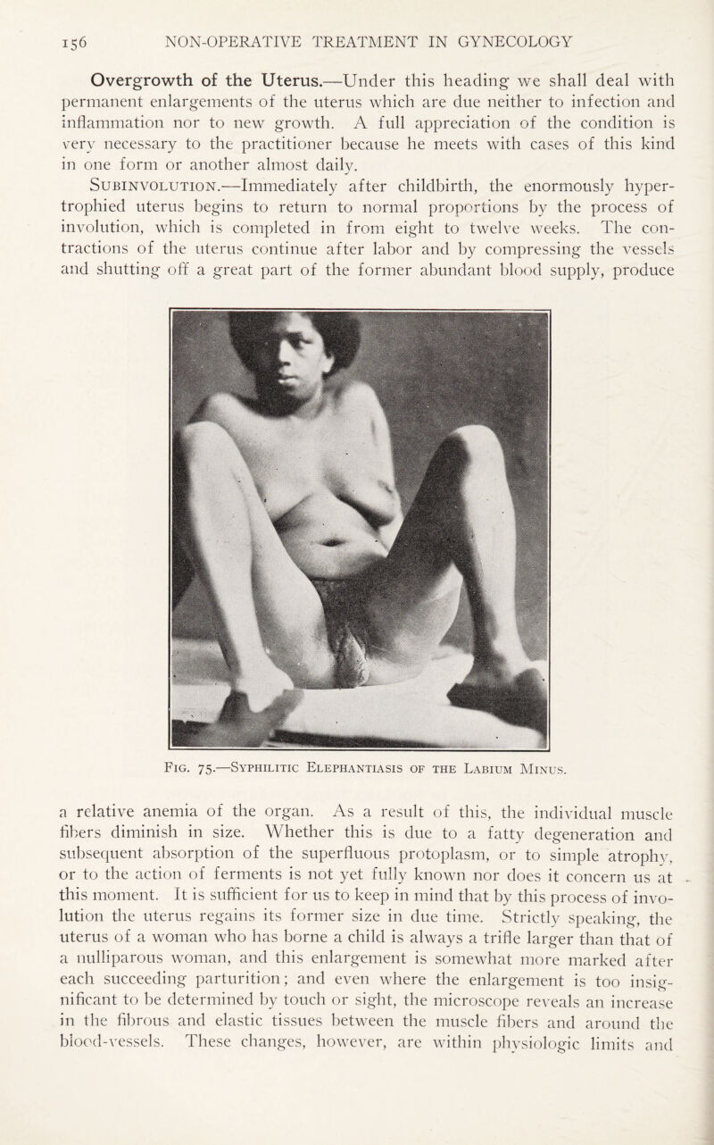Overgrowth of the Uterus.—Under this heading we shall deal with permanent enlargements of the uterus which are due neither to infection and inflammation nor to new growth. A full appreciation of the condition is very necessary to the practitioner because he meets with cases of this kind in one form or another almost daily. Subinvolution.—Immediately after childbirth, the enormously hyper¬ trophied uterus begins to return to normal proportions by the process of involution, which is completed in from eight to twelve weeks. The con¬ tractions of the uterus continue after labor and by compressing the vessels and shutting off a great part of the former abundant blood supply, produce Fig. 75.—Syphilitic Elephantiasis of the Labium Minus. a relative anemia of the organ. As a result of this, the individual muscle fibers diminish in size. Whether this is due to a fatty degeneration and subsequent absorption of the superfluous protoplasm, or to simple atrophv, or to the action of ferments is not yet fully known nor does it concern us at this moment. It is sufficient for us to keep in mind that by this process of invo¬ lution the uterus regains its former size in due time. Strictly speaking, the uterus of a woman who has borne a child is always a trifle larger than that of a nulliparous woman, and this enlargement is somewhat more marked after each succeeding parturition; and even where the enlargement is too insig¬ nificant to be determined by touch or sight, the microscope reveals an increase in the fibrous and elastic tissues between the muscle fibers and around the blood-vessels. These changes, however, are within physiologic limits and
