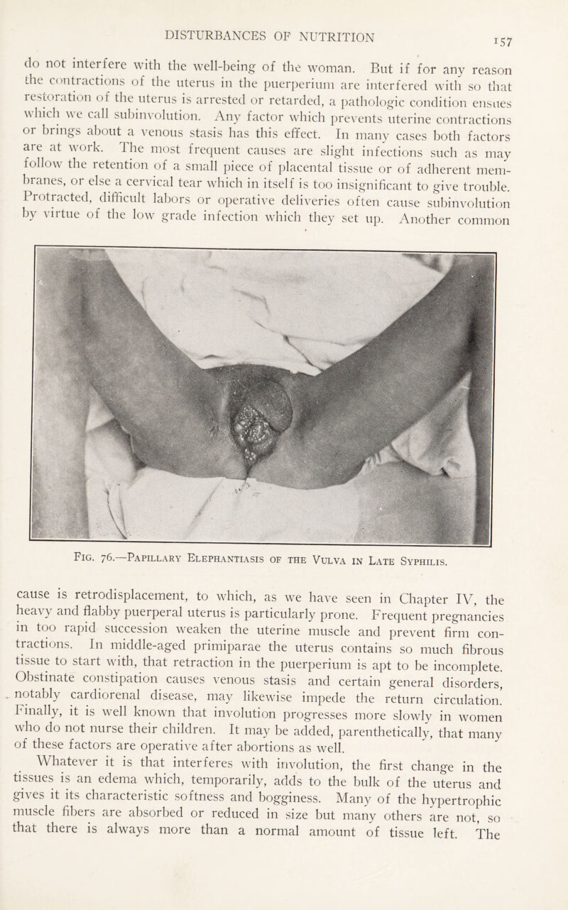 157 do not interfere with the well-being of the woman. But if for any reason the contractions of the uterus in the puerperium are interfered with so that lestoiation of the uterus is arrested or retarded, a pathologic condition ensues which we call subinvolution. Any factor which prevents uterine contractions or brings about a venous stasis has this effect. In many cases both factors are at work. The most frequent causes are slight infections such as may follow the retention of a small piece of placental tissue or of adherent mem- branes, or else a cei \ ical tear which in itself is too insignificant to give trouble. Protracted, difficult labors or operative deliveries often cause subinvolution by virtue of the low grade infection which they set up. Another common Fig. 76—Papillary Elephantiasis of the Vulva in Late Syphilis. cause is retrodisplacement, to which, as we have seen in Chapter IV, the heavy and flabby puerperal uterus is particularly prone. Frequent pregnancies m too rapid succession weaken the uterine muscle and prevent firm con¬ tractions. In middle-aged primiparae the uterus contains so much fibrous tissue to start with, that retraction in the puerperium is apt to be incomplete. Obstinate constipation causes venous stasis and certain general disorders, notably cardiorenal disease, may likewise impede the return circulation. Finally, it is well known that involution progresses more slowly in women who do not nurse their children. It may be added, parenthetically, that many of these factors are operative after abortions as well. Whatever it is that interferes with involution, the first change in the tissues is an edema which, temporarily, adds to the bulk of the uterus and gives it its characteristic softness and bogginess. Many of the hypertrophic muscle fibers are absorbed or reduced in size but many others are not, so that there is always more than a normal amount of tissue left. The