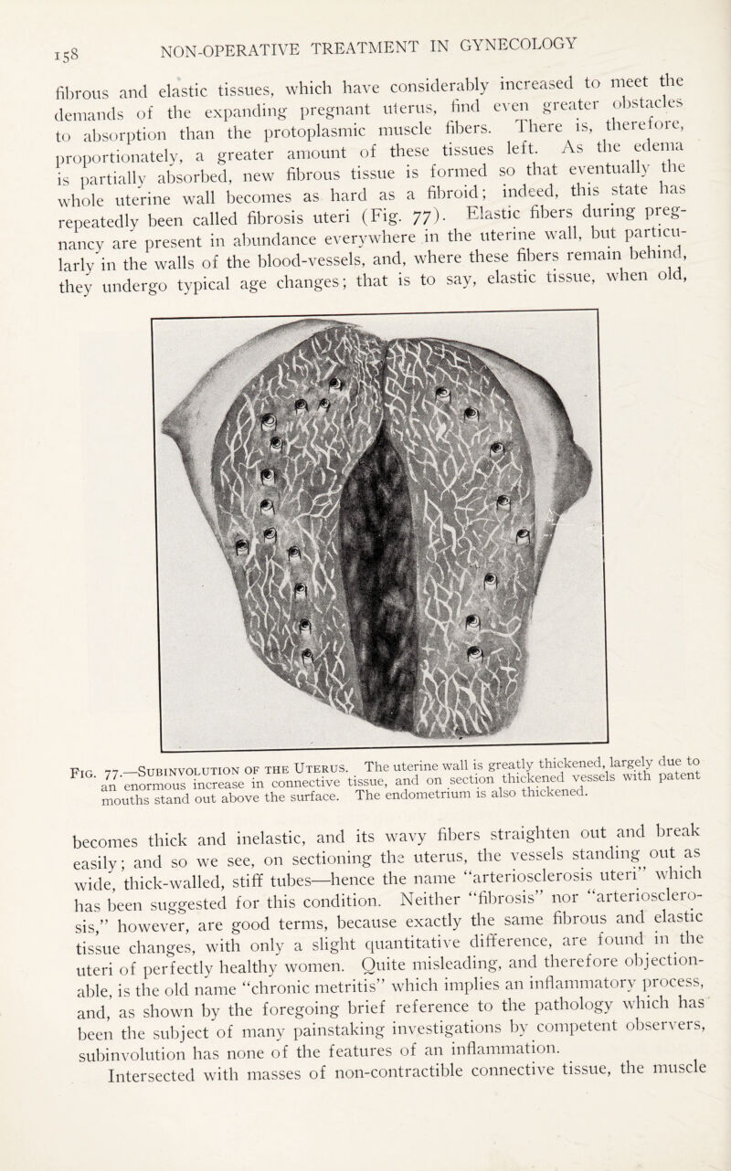fibrous and elastic tissues, which have considerably increased to meet the demands of the expanding pregnant uterus, find even greater obstac es to absorption than the protoplasmic muscle fibers. There is, there me, proportionately, a greater amount of these tissues left As the edema is partially absorbed, new fibrous tissue is formed so that eventually tie whole uterine wall becomes as hard as a fibroid; indeed, this state las repeatedly been called fibrosis uteri (Fig. 77)- Elastic fibers during preg¬ nancy are present in abundance everywhere in the uterine wall, but particu¬ larly in the walls of the blood-vessels, and, where these fibers remain behind, they undergo typical age changes; that is to say, elastic tissue, when old, Fig. 7 —Subinvolution of the Uterus. The uterine wall is greatly thickened largely due to Ln~Tnele0ase°in connective tissue, and on section thickened vessels with patent ouths stand out above the surface. The endometrium is also thickened. becomes thick and inelastic, and its wavy fibers straighten out and break easily and so we see, on sectioning the uterus, the vessels standing out as wide, thick-walled, stiff tubes—hence the name arteriosclerosis uteri” which has been suggested for this condition. Neither fibrosis” nor arteriosclero¬ sis,” however, are good terms, because exactly the same fibrous and elastic tissue changes, with only a slight quantitative difference, are found m the uteri of perfectly healthy women. Quite misleading, and therefore objection¬ able, is the old name chronic metritis which implies an inflammatory process, and, as shown by the foregoing brief reference to the pathology which has been the subject of many painstaking investigations bv competent observers, subinvolution has none of the features of an inflammation. Intersected with masses of non-contractible connective tissue, the muscle