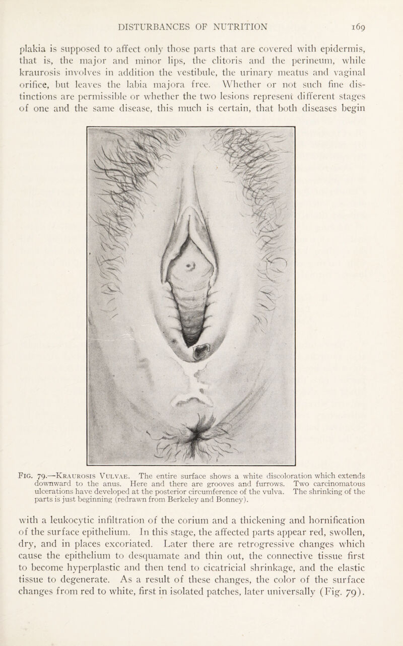 plakia is supposed to affect only those parts that are covered with epidermis, that is, the major and minor lips, the clitoris and the perineum, while kraurosis involves in addition the vestibule, the urinary meatus and vaginal orifice, but leaves the labia majora free. Whether or not such fine dis¬ tinctions are permissible or whether the two lesions represent different stages of one and the same disease, this much is certain, that both diseases begin Fig. 79.—-Kraurosis Vulvae. The entire surface shows a white discoloration which extends downward to the anus. Here and there are grooves and furrows. Two carcinomatous ulcerations have developed at the posterior circumference of the vulva. The shrinking of the parts is just beginning (redrawn from Berkeley and Bonney). with a leukocytic infiltration of the corium and a thickening and hornification of the surface epithelium. In this stage, the affected parts appear red, swollen, dry, and in places excoriated. Later there are retrogressive changes which cause the epithelium to desquamate and thin out, the connective tissue first to become hyperplastic and then tend to cicatricial shrinkage, and the elastic tissue to degenerate. As a result of these changes, the color of the surface changes from red to white, first in isolated patches, later universally (Fig. 79).