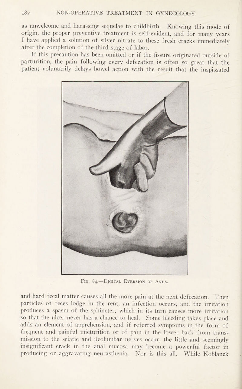 as unwelcome and harassing sequelae to childbirth. Knowing this mode of origin, the proper preventive treatment is self-evident, and for many years I have applied a solution of silver nitrate to these fresh cracks immediately after the completion of the third stage of labor. If this precaution has been omitted or if the fissure originated outside of parturition, the pain following every defecation is often so great that the patient voluntarily delays bowel action with the result that the inspissated Fig. 84.—Digital Eversion of Anus. and hard fecal matter causes all the more pain at the next defecation. Then particles of feces lodge in the rent, an infection occurs, and the irritation produces a spasm of the sphincter, which in its turn causes more irritation so that the ulcer never has a chance to heal. Some bleeding takes place and adds an element of apprehension, and if referred symptoms in the form of frequent and painful micturition or of pain in the lower back from trans¬ mission to the sciatic and ileolumbar nerves occur, the little and seemingly insignificant crack in the anal mucosa may become a powerful factor in producing or aggravating neurasthenia. Nor is this all. While Koblanck