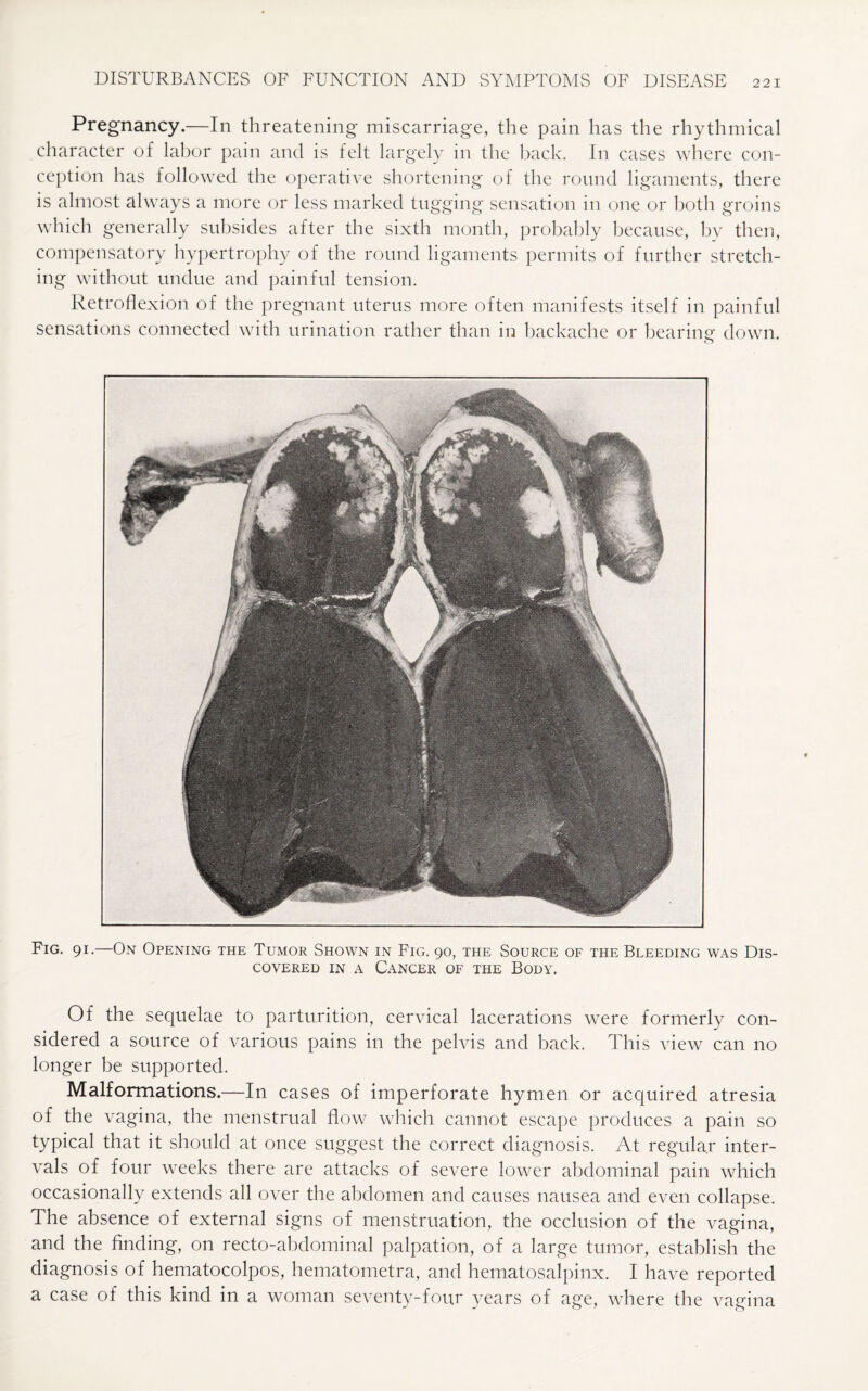 Pregnancy.—In threatening miscarriage, the pain has the rhythmical character of labor pain and is felt largely in the back. In cases where con¬ ception has followed the operative shortening of the round ligaments, there is almost always a more or less marked tugging sensation in one or both groins which generally subsides after the sixth month, probably because, by then, compensatory hypertrophy of the round ligaments permits of further stretch¬ ing without undue and painful tension. Retroflexion of the pregnant uterus more often manifests itself in painful sensations connected with urination rather than in backache or bearing- down. o Fig. 91.—On Opening the Tumor Shown in Fig. 90, the Source of the Bleeding was Dis¬ covered in a Cancer of the Body. Of the sequelae to parturition, cervical lacerations were formerly con¬ sidered a source of various pains in the pelvis and back. This view can no longer be supported. Malformations.—In cases of imperforate hymen or acquired atresia of the vagina, the menstrual flow which cannot escape produces a pain so typical that it should at once suggest the correct diagnosis. At regular inter¬ vals of four weeks there are attacks of severe lower abdominal pain which occasionally extends all over the abdomen and causes nausea and even collapse. The absence of external signs of menstruation, the occlusion of the vagina, and the finding, on recto-abdominal palpation, of a large tumor, establish the diagnosis of hematocolpos, hematometra, and hematosalpinx. I have reported a case of this kind in a woman seventy-four years of age, where the vagina
