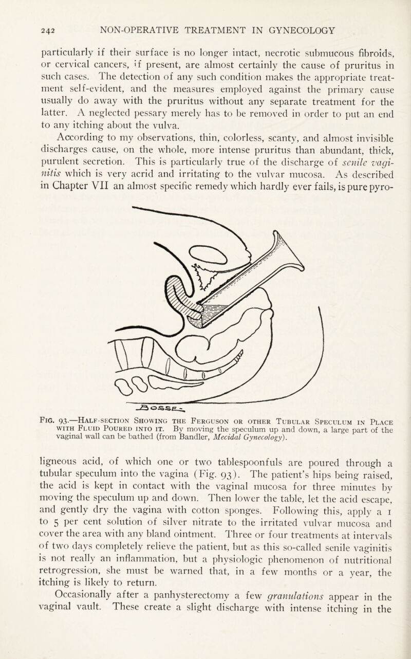 particularly if their surface is no longer intact, necrotic submucous fibroids, or cervical cancers, if present, are almost certainly the cause of pruritus in such cases. The detection of any such condition makes the appropriate treat¬ ment self-evident, and the measures employed against the primary cause usually do away with the pruritus without any separate treatment for the latter. A neglected pessary merely has to be removed in order to put an end to any itching about the vulva. According to my observations, thin, colorless, scanty, and almost invisible discharges cause, on the whole, more intense pruritus than abundant, thick, purulent secretion. This is particularly true of the discharge of senile vagi¬ nitis which is very acrid and irritating to the vulvar mucosa. As described in Chapter VII an almost specific remedy which hardly ever fails, is pure pyro- Fig. 93.—Half-section Showing the Ferguson or other Tubular Speculum in Place with Fluid Poured into it. By moving the speculum up and down, a large part of the vaginal wall can be bathed (from Bandler, Mecidal Gynecology). ligneous acid, of which one or two tablespoonfuls are poured through a tubular speculum into the vagina (Fig. 93). The patient’s hips being raised, the acid is kept in contact with the vaginal mucosa for three minutes by moving the speculum up and down. Then lower the table, let the acid escape, and gently dry the vagina with cotton sponges. Following this, apply a 1 to 5 per cent solution of silver nitrate to the irritated vulvar mucosa and cover the area with any bland ointment. Three or four treatments at intervals of two days completely relieve the patient, but as this so-called senile vaginitis is not really an inflammation, but a physiologic phenomenon of nutritional retrogression, she must be warned that, in a few months or a year, the itching is likely to return. Occasionally after a panhysterectomy a few granulations appear in the vaginal vault. These create a slight discharge with intense itching in the