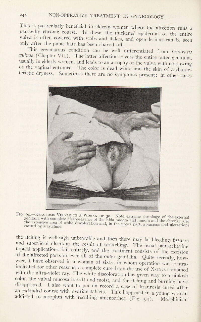 This is particularly beneficial in elderly women where the affection runs a markedly chronic course. In these, the thickened epidermis of the entire vulva is often covered with scabs and flakes, and open lesions can be seen only after the pubic hair has been shaved off. This eczematous condition can be well differentiated from kraurosis vulvae (Chapter VII). The latter affection covers the entire outer genitalia, usually in elderly women, and leads to an atrophy of the vulva with narrowing of the vaginal entrance. The color is dead white and the skin of a charac¬ teristic dryness. Sometimes there are no symptoms present; in other cases Fig. 94. Kraurosis Vulvae in a Woman of 30. Note extreme shrinkage of the external genitalia with complete disappearance of the labia majora and minora and the clitoris- also c^sfd^raTcSnl ^ dlSC“°n “d- “ the ^ part, abrasionfan^St.pS the itching is well-nigh unbearable and then there may be bleeding fissures and superficial ulcers as the result of scratching. The usual pain-relieving epical applications fail entirely, and the treatment consists of the excision ot the affected parts or even all of the outer genitalia. Quite recently, how¬ ever, rave observed in a woman of sixty, in whom operation was contra¬ indicated for other reasons, a complete cure from the use of X-rays combined with the ultra-violet ray. The white discoloration has given way to a pinkish color, the vulval mucosa is soft and moist, and the itching and burning have disappeared. I also want to put on record a case of kraurosis cured after an extended course with ovarian tablets. This happened in a young woman addicted to morphm with resulting amenorrhea (Fig. 94). Morphinism