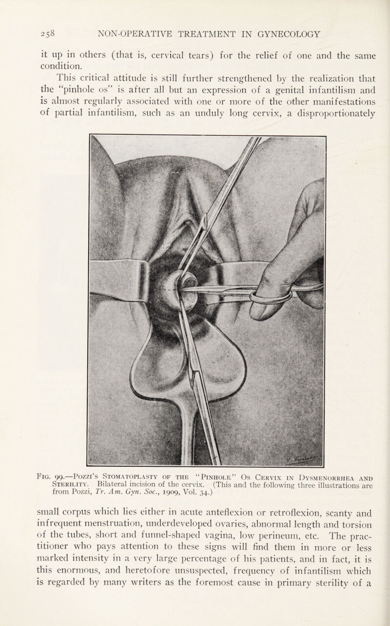 it up in others (that is, cervical tears) for the relief of one and the same condition. This critical attitude is still further strengthened by the realization that the “pinhole os” is after all hut an expression of a genital infantilism and is almost regularly associated with one or more of the other manifestations of partial infantilism, such as an unduly long cervix, a disproportionately Fig. 99.—Pozzi’s Stomatoplasty of the “Pinhole” Os Cervix in Dysmenorrhea and Sterility. Bilateral incision of the cervix. (This and the following three illustrations are from Pozzi, Tr. Am. Gyn. Soc., 1909, Vol. 34.) small corpus which lies either in acute anteflexion or retroflexion, scanty and infrequent menstruation, underdeveloped ovaries, abnormal length and torsion of the tubes, short and funnel-shaped vagina, low perineum, etc. The prac¬ titioner who pays attention to these signs will find them in more or less marked intensity in a very large percentage of his patients, and in fact, it is this enormous, and heretofore unsuspected, frequency of infantilism which is regarded by many writers as the foremost cause in primary sterility of a