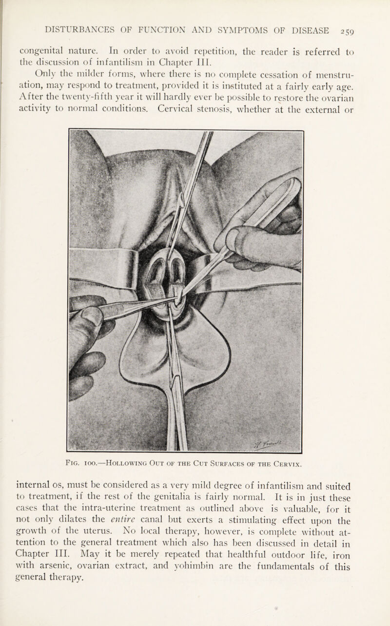 congenital nature. In order to avoid repetition, the reader is referred to the discussion of infantilism in Chapter III. Only the milder forms, where there is no complete cessation of menstru¬ ation, may respond to treatment, provided it is instituted at a fairly early age. After the twenty-fifth year it will hardly ever be possible to restore the ovarian activity to normal conditions. Cervical stenosis, whether at the external or Fig. 100.—Hollowing Out of the Cut Surfaces of the Cervix. internal os, must be considered as a very mild degree of infantilism and suited to treatment, if the rest of the genitalia is fairly normal. It is in just these cases that the intra-uterine treatment as outlined above is valuable, for it not only dilates the entire canal but exerts a stimulating effect upon the growth of the uterus. No local therapy, however, is complete without at¬ tention to the general treatment which also has been discussed in detail in Chapter III. May it be merely repeated that healthful outdoor life, iron with arsenic, ovarian extract, and yohimbin are the fundamentals of this general therapy.