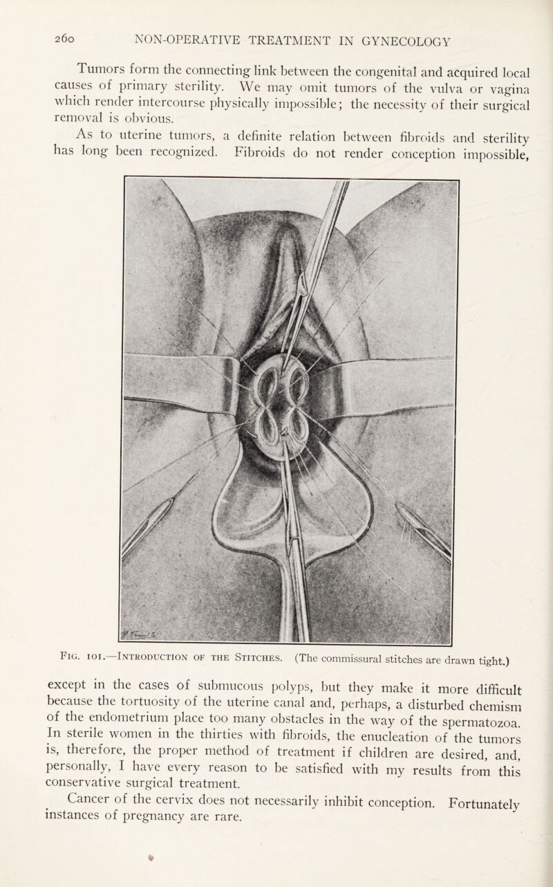 Tumors form the connecting link between the congenital and acquired local causes of primary sterility. We may omit tumors of the vulva or vagina which render intercourse physically impossible; the necessity of their surgical removal is obvious. As to uterine tumors, a definite relation between fibroids and sterility has long been recognized. Fibroids do not render conception impossible, Fig. ioi. Introduction of the Stitches. (The commissural stitches are drawn tight.) except in the cases of submucous polyps, but they make it more difficult because the tortuosity of the uterine canal and, perhaps, a disturbed chemism of the endometrium place too many obstacles in the way of the spermatozoa. In sterile women in the thirties with fibroids, the enucleation of the tumors is, therefore, the proper method of treatment if children are desired, and, personally, I have every reason to be satisfied with my results from this conservative surgical treatment. Cancer of the cervix does not necessarily inhibit conception. Fortunately instances of pregnancy are rare.