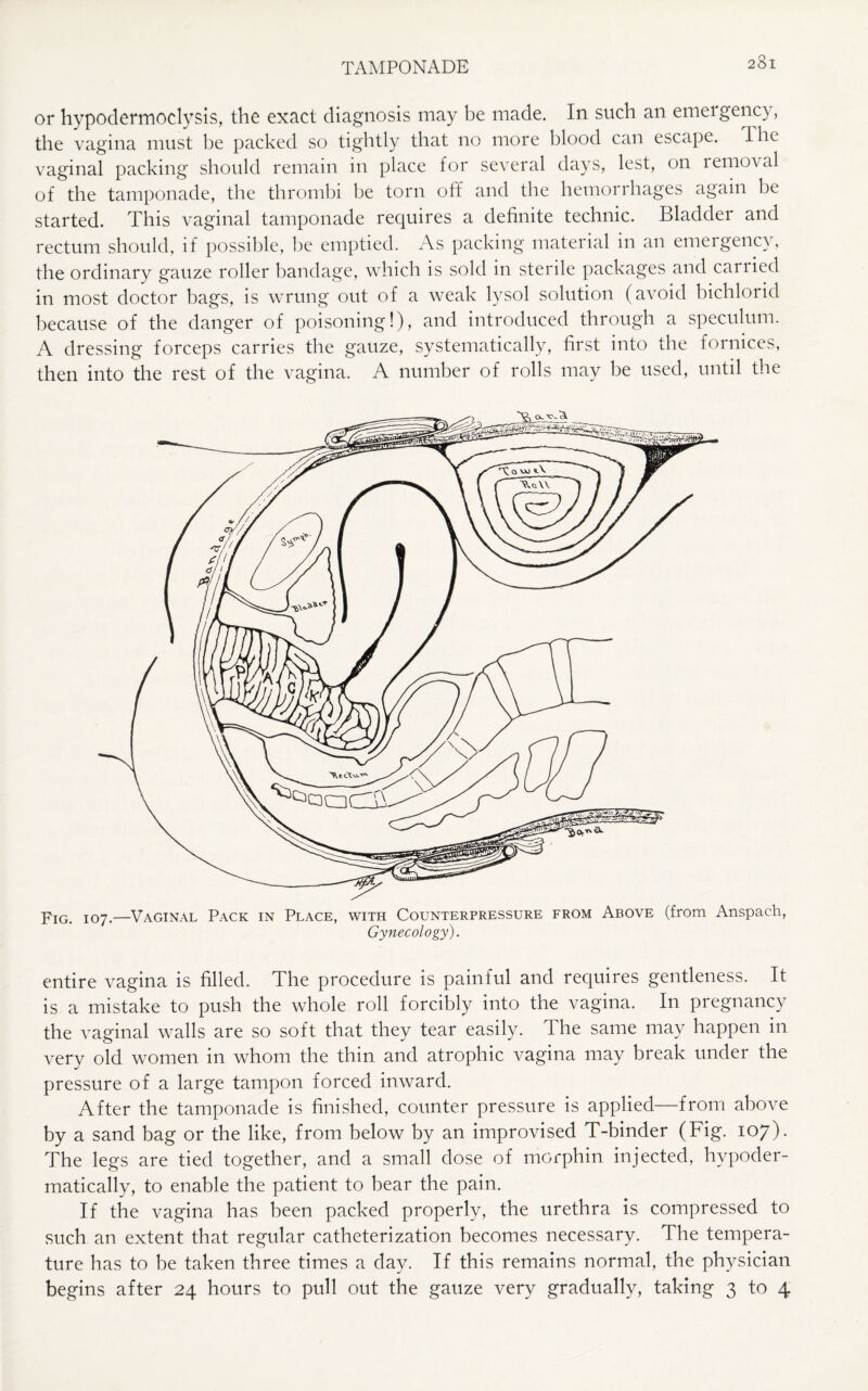 or hypodermoclysis, the exact diagnosis may be made. In such an emergency, the vagina must be packed so tightly that no more blood can escape, the vaginal packing should remain in place for several days, lest, on removal of the tamponade, the thrombi be torn off and the hemorrhages again be started. This vaginal tamponade requires a definite technic. Bladder and rectum should, if possible, be emptied. As packing material in an emergency, the ordinary gauze roller bandage, which is sold in sterile packages and caiiied in most doctor bags, is wrung out of a weak lysol solution (avoid bichlorid because of the danger of poisoning!), and introduced through a speculum. A dressing forceps carries the gauze, systematically, first into the fornices, then into the rest of the vagina. A number of rolls may be used, until the Fig. 107.—Vaginal Pack in Place, with Counterpressure from Above (from Anspach, Gynecology). entire vagina is filled. The procedure is painful and requires gentleness. It is a mistake to push the whole roll forcibly into the vagina. In pregnancy the vaginal walls are so soft that they tear easily. The same may happen in very old women in whom the thin and atrophic vagina may break under the pressure of a large tampon forced inward. After the tamponade is finished, counter pressure is applied—from above by a sand bag or the like, from below by an improvised T-binder (Fig. 107). The legs are tied together, and a small dose of morphin injected, hypoder- matically, to enable the patient to bear the pain. If the vagina has been packed properly, the urethra is compressed to such an extent that regular catheterization becomes necessary. The tempera¬ ture has to be taken three times a day. If this remains normal, the physician begins after 24 hours to pull out the gauze very gradually, taking 3 to 4