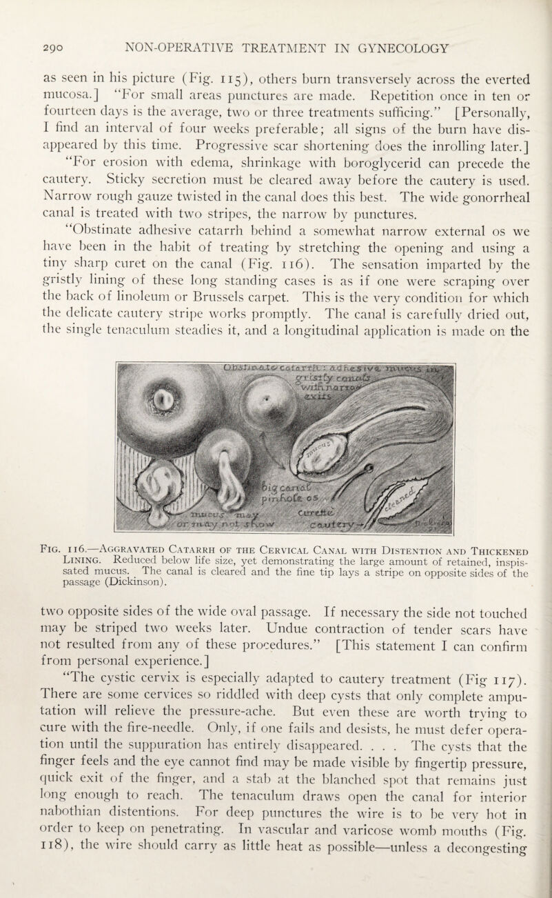 as seen in his picture (Fig. 115), others burn transversely across the everted mucosa.] “For small areas punctures are made. Repetition once in ten or fourteen days is the average, two or three treatments sufficing.” [Personally, I find an interval of four weeks preferable; all signs of the burn have dis¬ appeared by this time. Progressive scar shortening does the inrolling later.] “For erosion with edema, shrinkage with boroglycerid can precede the cautery. Sticky secretion must he cleared away before the cautery is used. Narrow rough gauze twisted in the canal does this best. The wide gonorrheal canal is treated with two stripes, the narrow by punctures. “Obstinate adhesive catarrh behind a somewhat narrow external os we have been in the habit of treating by stretching the opening and using a tiny sharp curet on the canal (Fig. 116). The sensation imparted by the gristly lining of these long standing cases is as if one were scraping over the back of linoleum or Brussels carpet. This is the very condition for which the delicate cautery stripe works promptly. The canal is carefully dried out, the single tenaculum steadies it, and a longitudinal application is made on the Fig. 116.—Aggravated Catarrh of the Cervical Canal with Distention and Thickened Lining. Reduced below life size, yet demonstrating the large amount of retained, inspis¬ sated mucus. . The canal is cleared and the fine tip lays a stripe on opposite sides of the passage (Dickinson). two opposite sides of the wide oval passage. If necessary the side not touched may be striped two weeks later. Undue contraction of tender scars have not resulted from any of these procedures.” [This statement I can confirm from personal experience.] “The cystic cervix is especially adapted to cautery treatment (Fig 117). There are some cervices so riddled with deep cysts that only complete ampu¬ tation will relieve the pressure-ache. But even these are worth trying to cure with the fire-needle. Only, if one fails and desists, he must defer opera¬ tion until the suppuration has entirely disappeared. . . . The cysts that the finger feels and the eye cannot find may be made visible by fingertip pressure, quick exit of the finger, and a stab at the blanched spot that remains just long enough to reach. The tenaculum draws open the canal for interior nabothian distentions. For deep punctures the wire is to be very hot in order to keep on penetrating. In vascular and varicose womb mouths (Fig. 118), the wire should carry as little heat as possible—unless a decongesting