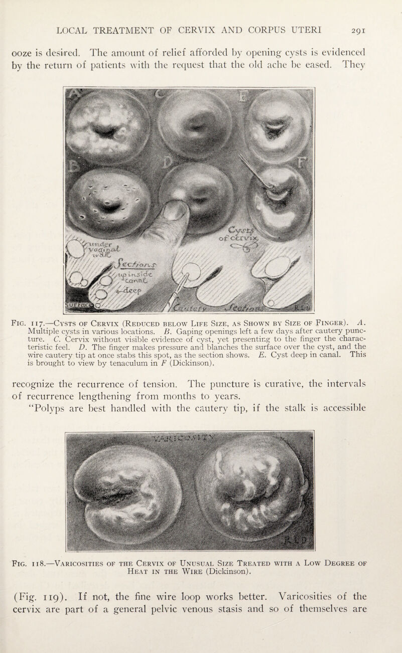 ooze is desired. The amount of relief afforded by opening cysts is evidenced by the return of patients with the request that the old ache he eased. They Fig. 117.—Cysts of Cervix (Reduced below Life Size, as Shown by Size of Finger). A. Multiple cysts in various locations. B. Gaping openings left a few days after cautery punc¬ ture. C. Cervix without visible evidence of cyst, yet presenting to the finger the charac¬ teristic feel. D. The finger makes pressure and blanches the surface over the cyst, and the wire cautery tip at once stabs this spot, as the section shows. E. Cyst deep in canal. This is brought to view by tenaculum in F (Dickinson). recognize the recurrence of tension. The puncture is curative, the intervals of recurrence lengthening from months to years. “Polyps are best handled with the cautery tip, if the stalk is accessible Fig. 118.—Varicosities of the Cervix of Unusual Size Treated with a Low Degree of Heat in the Wire (Dickinson). (Fig. 119). If not, the fine wire loop works better. Varicosities of the cervix are part of a general pelvic venous stasis and so of themselves are