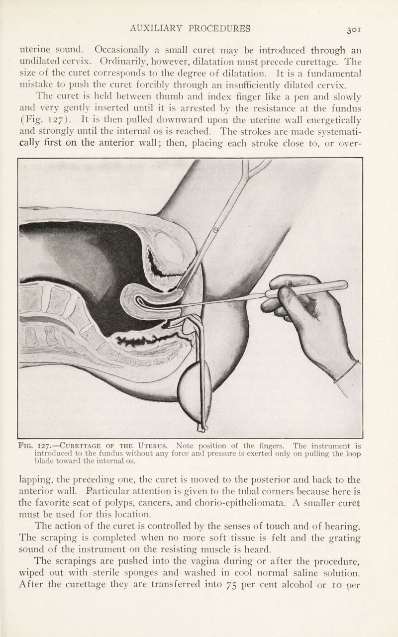 3QI uterine sound. Occasionally a small curet may be introduced through an undilated cervix. Ordinarily, however, dilatation must precede curettage. The size of the curet corresponds to the degree of dilatation. It is a fundamental mistake to push the curet forcibly through an insufficiently dilated cervix. 1 he curet is held between thumb and index finger like a pen and slowly and very gently inserted until it is arrested by the resistance at the fundus (Fig. 127). It is then pulled downward upon the uterine wall energetically and strongly until the internal os is reached. The strokes are made systemati¬ cally first on the anterior wall; then, placing each stroke close to, or over- Fig. 127.—Curettage of the Uterus. Note position of the fingers. The instrument is introduced to the fundus without any force and pressure is exerted only on pulling the loop blade toward the internal os. lapping, the preceding one, the curet is moved to the posterior and back to the anterior wall. Particular attention is given to the tubal corners because here is the favorite seat of polyps, cancers, and chorio-epitheliomata. A smaller curet must be used for this location. The action of the curet is controlled by the senses of touch and of hearing. The scraping is completed when no more soft tissue is felt and the grating sound of the instrument on the resisting muscle is heard. The scrapings are pushed into the vagina during or after the procedure, wiped out with sterile sponges and washed in cool normal saline solution.