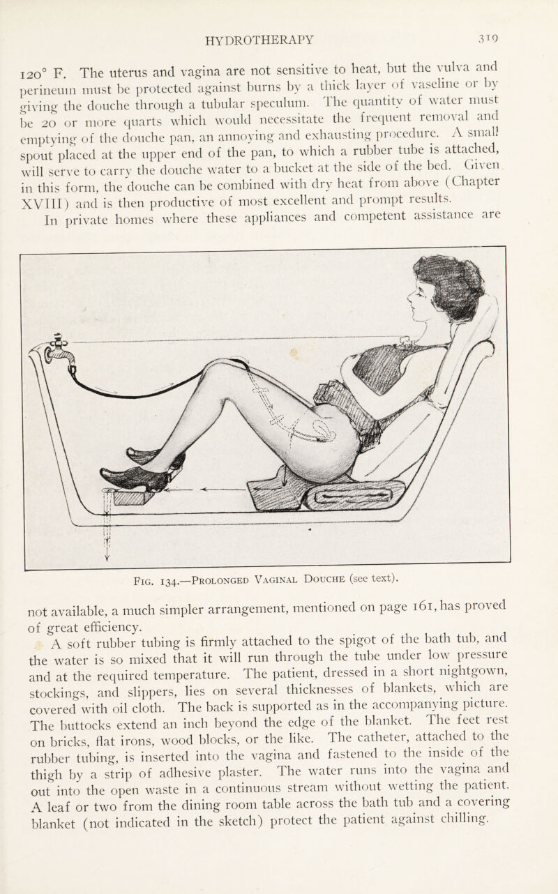 120° F. The uterus and vagina are not sensitive to heat, but the vulva and perineum must be protected against burns by a thick layer of vaseline or by giving the douche through a tubular speculum. The quantity of water must be 20 or more quarts which would necessitate the frequent removal and emptying of the douche pan, an annoying and exhausting procedure. A small spout placed at the upper end of the pan, to which a rubber tube is attached, will serve to carry the douche water to a bucket at the side of the bed. ^ CIi\ en in this form, the douche can be combined with dry heat from above ( Chapter XVIII) and is then productive of most excellent and prompt results. In private homes where these appliances and competent assistance are •ry -; rqi.iiW lnmWHMw Prolonged Vaginal Douche (see text) not available, a much simpler arrangement, mentioned on page i6i,has proved of great efficiency. A soft rubber tubing is firmly attached to the spigot of the bath tub, and the water is so mixed that it will run through the tube under low pressure and at the required temperature. The patient, dressed in a short nightgown, stockings, and slippers, lies on several thicknesses of blankets, which are covered with oil cloth. The back is supported as in the accompanying picture. The buttocks extend an inch beyond the edge of the blanket. The feet rest on bricks, flat irons, wood blocks, or the like. The cathetei, attached to the rubber tubing, is inserted into the vagina and fastened to the inside of the thigh by a strip of adhesive plaster. The water runs into the vagina and out into the open waste in a continuous stream without wetting the patient. A leaf or two from the dining room table across the bath tub and a cohering blanket (not indicated in the sketch) protect the patient against chilling.