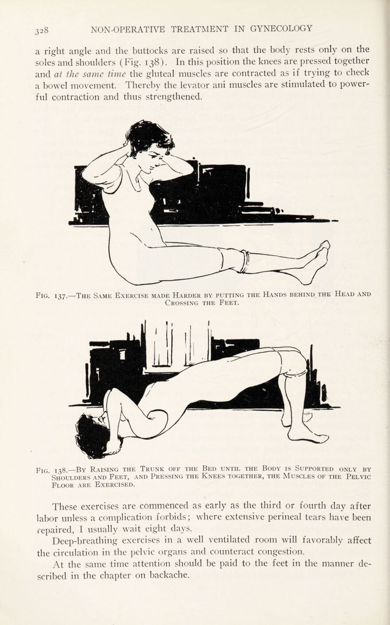 a right angle and the buttocks are raised so that the body rests only on the soles and shoulders (Fig. 138). In this position the knees are pressed together and at the same time the gluteal muscles are contracted as if trying to check a bowel movement. Thereby the levator ani muscles are stimulated to power¬ ful contraction and thus strengthened. Fig. 137.—The Same Exercise made Harder by putting the Hands behind the Head and Crossing the Feet. pIG —By Raising the Trunk off the Bed until the Body is Supported only by Shoulders and Feet, and Pressing the Knees together, the Muscles of the Pelvic Floor are Exercised. These exercises are commenced as early as the third or fourth day after labor unless a complication forbids; where extensive perineal tears have been repaired, I usually wait eight days. Deep-breathing exercises in a well ventilated room will favorably affect the circulation in the pelvic organs and counteract congestion. At the same time attention should be paid to the feet in the manner de¬ scribed in the chapter on backache.
