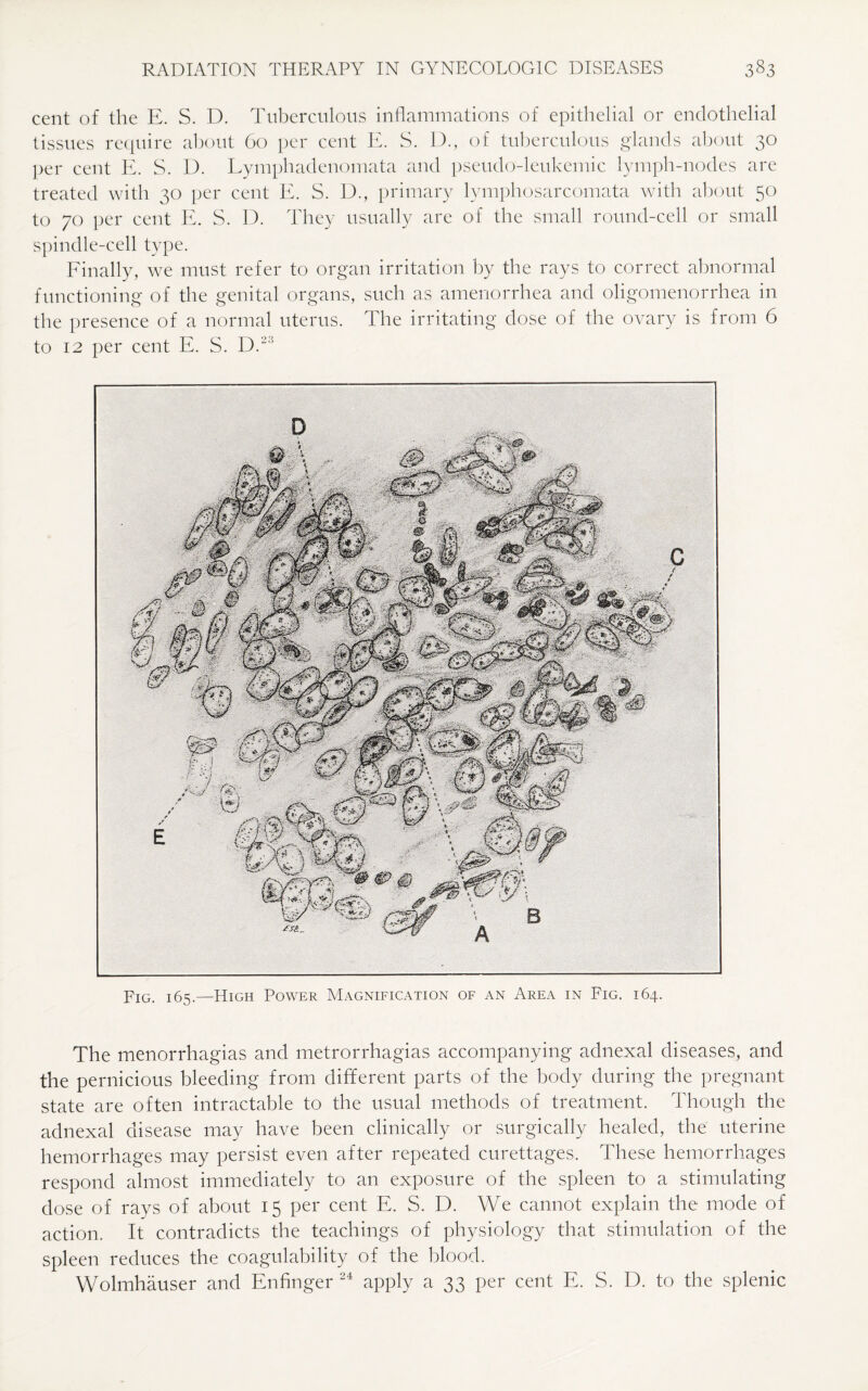 cent of the E. S. D. Tuberculous inflammations of epithelial or endothelial tissues require about 60 per cent E. S. D., of tuberculous glands about 30 per cent E. S. D. Lymphadenomata and pseudo-leukemic lymph-nodes are treated with 30 per cent E. S. D., primary lymphosarcomata with about 50 to 70 per cent E. S. D. They usually are of the small round-cell or small spindle-cell type. Finally, we must refer to organ irritation by the rays to correct abnormal functioning of the genital organs, such as amenorrhea and oligomenorrhea in the presence of a normal uterus. The irritating dose of the ovary is from 6 to 12 per cent E. S. D.23 Fig. 165.—High Power Magnification of an Area in Fig. 164. The menorrhagias and metrorrhagias accompanying adnexal diseases, and the pernicious bleeding from different parts of the body during the pregnant state are often intractable to the usual methods of treatment. Though the adnexal disease may have been clinically or surgically healed, the uterine hemorrhages may persist even after repeated curettages. These hemorrhages respond almost immediately to an exposure of the spleen to a stimulating dose of rays of about 15 per cent E. S. D. We cannot explain the mode of action. It contradicts the teachings of physiology that stimulation of the spleen reduces the coagulability of the blood. Wolmhauser and Enfinger 24 apply a 33 per cent E. S. D. to the splenic