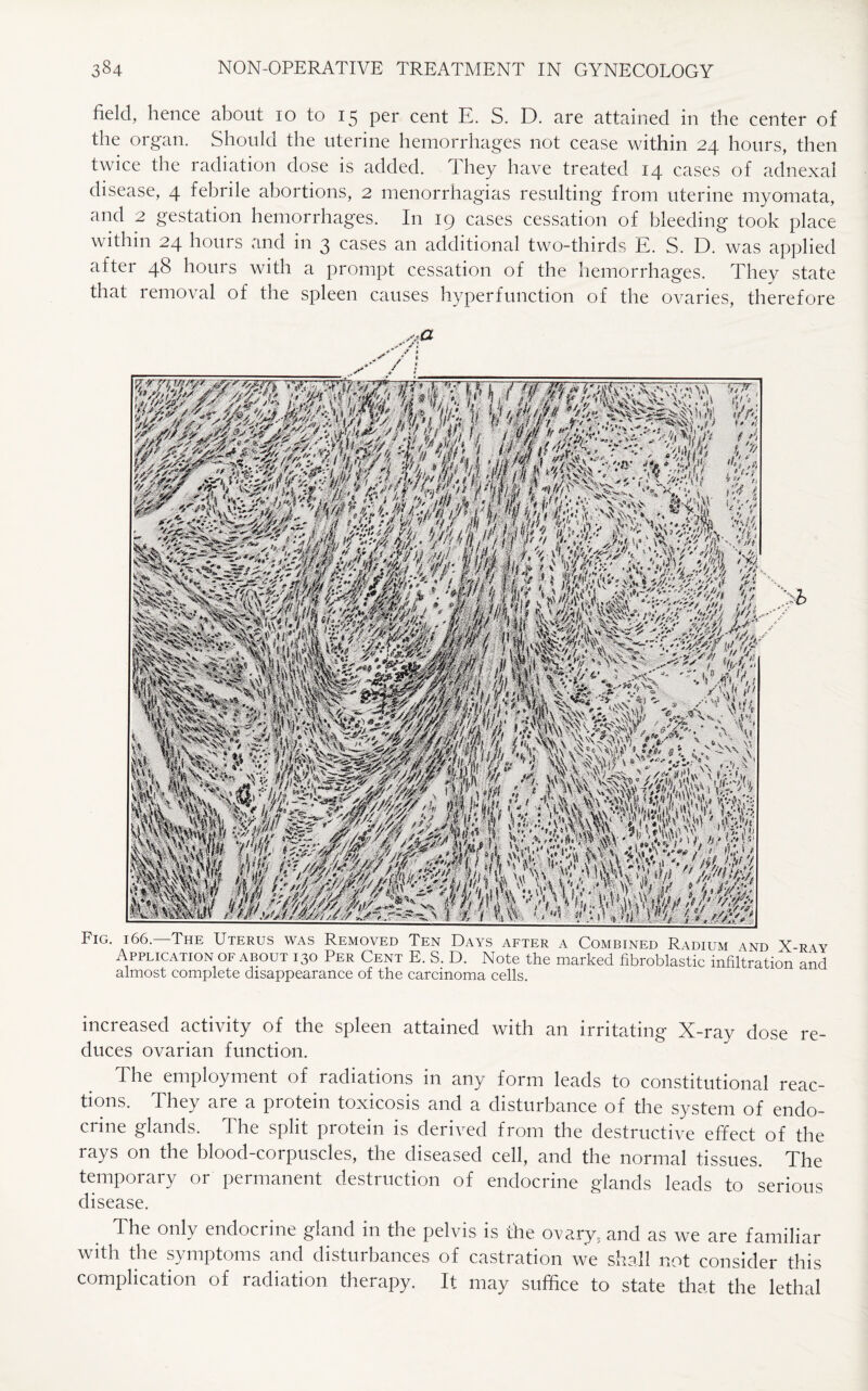 field, hence about 10 to 15 per cent E. S. D. are attained in the center of the organ. Should the uterine hemorrhages not cease within 24 hours, then twice the radiation dose is added. They have treated 14 cases of adnexal disease, 4 febrile abortions, 2 menorrhagias resulting from uterine myomata, and 2 gestation hemorrhages. I11 19 cases cessation of bleeding took place within 24 hours and in 3 cases an additional two-thirds E. S. D. was applied after 48 hours with a prompt cessation of the hemorrhages. They state that removal of the spleen causes hyperfunction of the ovaries, therefore Fig. 166.—The Uterus was Removed Ten Days after a Combined Radium and X-ray Application of about 130 Per Cent E. S. D. Note the marked fibroblastic infiltration and almost complete disappearance of the carcinoma cells. increased activity of the spleen attained with an irritating X-ray dose re¬ duces ovarian function. The employment of radiations in any form leads to constitutional reac¬ tions. They are a protein toxicosis and a disturbance of the system of endo¬ crine glands. The split protein is derived from the destructive effect of the rays on the blood-corpuscles, the diseased cell, and the normal tissues. The temporary or permanent destruction of endocrine glands leads to serious disease. The only endocrine gland in the pelvis is the ovary, and as we are familiar with the symptoms and disturbances of castration we shall not consider this complication of radiation therapy. It may suffice to state that the lethal