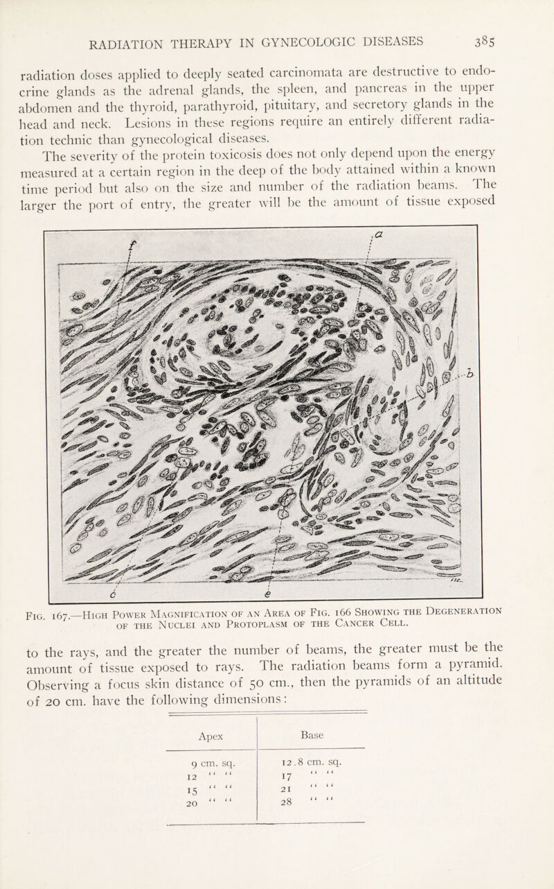 radiation doses applied to deeply seated carcinomata are destructive to endo¬ crine glands as the adrenal glands, the spleen, and pancreas in the upper abdomen and the thyroid, parathyroid, pituitary, and secretory glands in the head and neck. Lesions in these regions require an entirely different radia¬ tion technic than gynecological diseases. The severity of the protein toxicosis does not only depend upon the energy measured at a certain region in the deep of the body attained within a known time period but also on the size and number of the radiation beams. The larger the port of entry, the greater will be the amount of tissue exposed pIG I6y__High Power Magnification of an Area of Fig. 166 Showing the Degeneration of the Nuclei and Protoplasm of the Cancer Cell. to the rays, and the greater the number of beams, the greater must be the amount of tissue exposed to rays. The radiation beams form a pyramid. Observing a focus skin distance of 50 cm., then the pyramids of an altitude of 20 cm. have the following dimensions: Apex Base 9 cm. sq. 12.8 cm. sq. 12 “ “ 17 “ “ 15 “  21 “ “ 20 “ “ 28 “ “