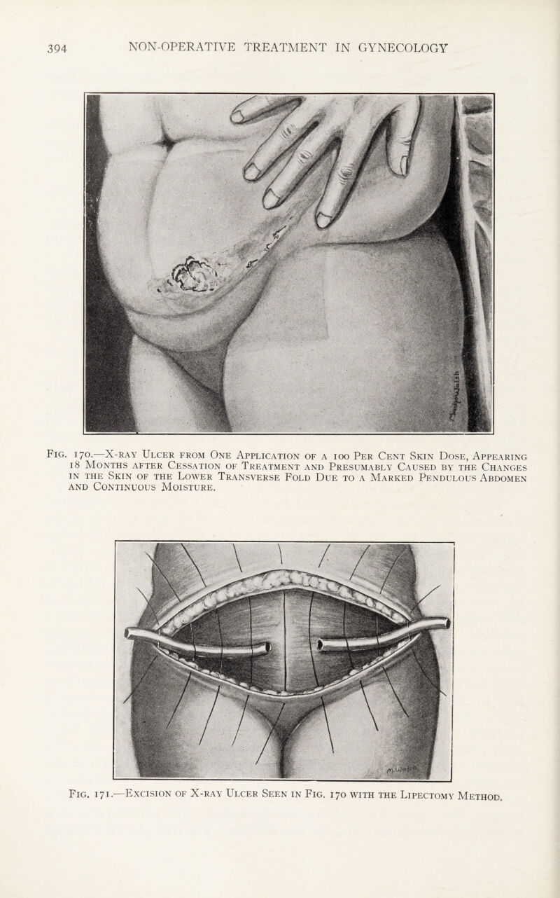 Fig. 170.—X-ray Ulcer from One Application of a ioo Per Cent Skin Dose, Appearing 18 Months after Cessation of Treatment and Presumably Caused by the Changes in the Skin of the Lower Transverse Fold Due to a Marked Pendulous Abdomen and Continuous Moisture.