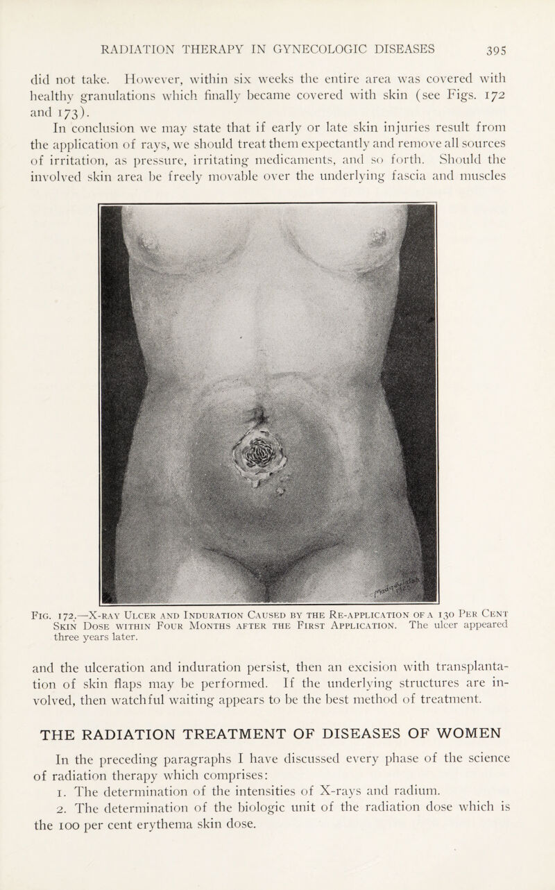 did not take. However, within six weeks the entire area was covered with healthy granulations which finally became covered with skin (see Figs. 172 and 173). In conclusion we may state that if early or late skin injuries result from the application of rays, we should treat them expectantly and remove all sources of irritation, as pressure, irritating medicaments, and so forth. Should the involved skin area he freely movable over the underlying fascia and muscles Fig. 172.—X-ray Ulcer and Induration Caused by the Re-application of a 130 Per Cent Skin Dose within Four Months after the First Application. The ulcer appeared three years later. and the ulceration and induration persist, then an excision with transplanta¬ tion of skin flaps may be performed. If the underlying structures are in¬ volved, then watchful waiting appears to be the best method of treatment. THE RADIATION TREATMENT OF DISEASES OF WOMEN In the preceding paragraphs I have discussed every phase of the science of radiation therapy which comprises: 1. The determination of the intensities of X-rays and radium. 2. The determination of the biologic unit of the radiation dose which is the 100 per cent erythema skin dose.