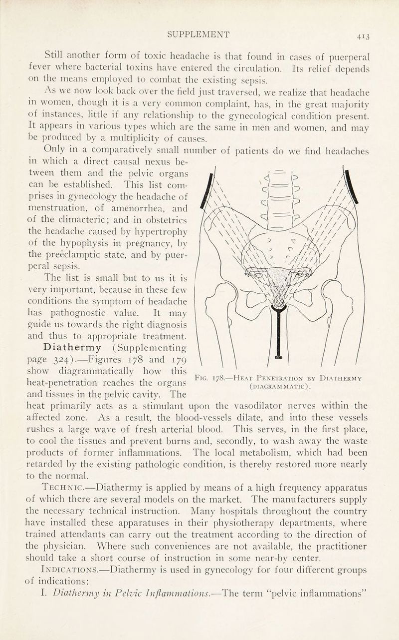 4M Still another form of toxic headache is that found in cases of puerperal fever where bacterial toxins have entered the circulation. Its relief depends on the means employed to combat the existing sepsis. As we now look back over the field just traversed, we realize that headache in women, though it is a very common complaint, has, in the great majority of instances, little if any relationship to the gynecological condition present. It appears in various types which are the same in men and women, and may be produced by a multiplicity of causes. Only in a comparatively small number of patients do we find headaches in which a direct causal nexus be¬ tween them and the pelvic organs can be established. This list com¬ prises in gynecology the headache of menstruation, of amenorrhea, and of the climacteric; and in obstetrics the headache caused by hypertrophy of the hypophysis in pregnancy, by the preeclamptic state, and by puer¬ peral sepsis. The list is small but to us it is very important, because in these few conditions the symptom of headache has pathognostic value. It may guide us towards the right diagnosis and thus to appropriate treatment. Diath ermy (Supplementing page 324).—Figures 178 and 179 show diagrammatically how this heat-penetration reaches the organs and tissues in the pelvic cavity. The heat primarily acts as a stimulant upon the vasodilator nerves within the affected zone. As a result, the blood-vessels dilate, and into these vessels rushes a large wave of fresh arterial blood. This serves, in the first place, to cool the tissues and prevent burns and, secondly, to wash away the waste products of former inflammations. The local metabolism, which had been retarded by the existing pathologic condition, is thereby restored more nearly to the normal. Fig. 178.—Heat Penetration by Diathermy (diagrammatic). Technic.—Diathermy is applied by means of a high frequency apparatus of which there are several models on the market. The manufacturers supply the necessary technical instruction. Many hospitals throughout the country have installed these apparatuses in their physiotherapy departments, where trained attendants can carry out the treatment according to the direction of the physician. Where such conveniences are not available, the practitioner should take a short course of instruction in some near-by center. Indications.—Diathermy is used in gynecology for four different groups of indications: