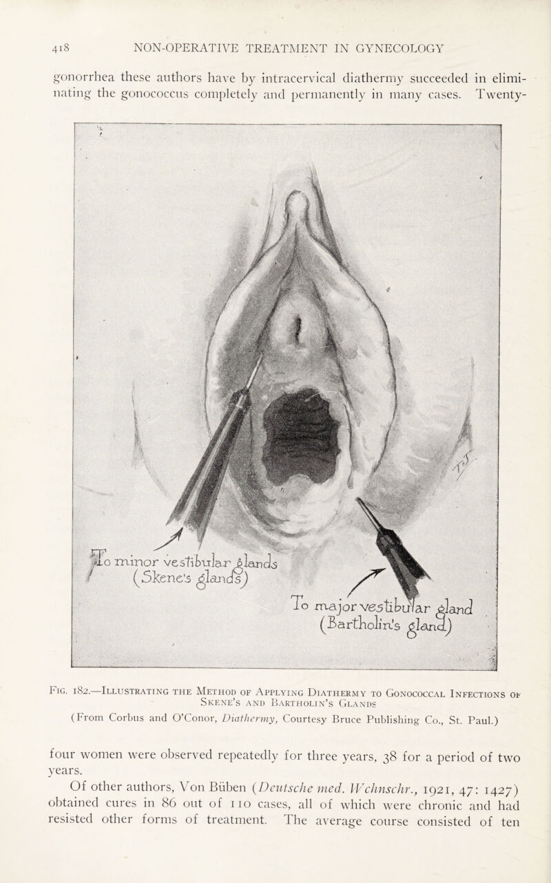 gonorrhea these authors have by intracervical diathermy succeeded in elimi¬ nating the gonococcus completely and permanently in many cases, Twenty- f % Fig. 182. Illustrating the Method of Applying Diathermy to Gonococcal Infections of Skene’s and Bartholin’s Glands (From Corbus and O’Conor, Diathermy, Courtesy Bruce Publishing Co., St. Paul.) four women were observed repeatedly for three years, 38 for a period of two years. Of other authors, Von Buben (Deutsche med. Wchnschr., 1921, 47: 1427) obtained cures in 86 out of no cases, all of which were chronic and had resisted other forms of treatment. the average course consisted of ten