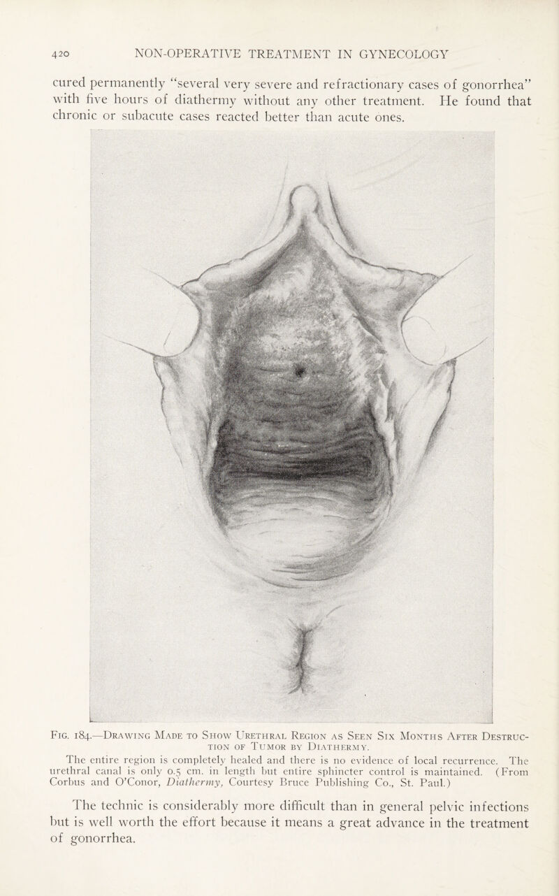 cured permanently “several very severe and refractionary cases of gonorrhea” with five hours of diathermy without any other treatment. He found that chronic or subacute cases reacted better than acute ones. Fig. 184.—Drawing Made to Show Urethral Region as Seen Six Months After Destruc¬ tion of Tumor by Diathermy. The entire region is completely healed and there is no evidence of local recurrence. The urethral canal is only 0.5 cm. in length but entire sphincter control is maintained. (From Corbus and O’Conor, Diathermy, Courtesy Bruce Publishing Co., St. Paul.) The technic is considerably more difficult than in general pelvic infections but is well worth the effort because it means a great advance in the treatment of gonorrhea.