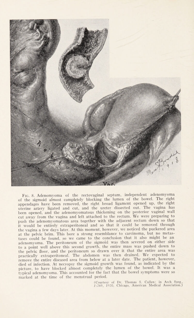 of the sigmoid almost completely blocking the lumen of the bowel. The right appendages have been removed, the right broad ligament opened up, the right uterine artery ligated and cut, and the ureter dissected out. 1 he vagina has been opened, and the adenomyomatous thickening on the posterior vaginal wall cut away from the vagina and left attached to the rectum. We were preparing to push the adenomyomatous area together with the adjacent rectum down so that it would be entirely extraperitoneal and so that it could be removed through the vagina a few days later. At this moment, however, we noticed the puckered area at the pelvic brim. This bore a strong resemblance to carcinoma, but no metas- tases could be found, so we came to the conclusion that it also might be an adenomyoma. The peritoneum of the sigmoid was then severed on either side to a point well above this second growth, the entire mass was pushed down to the pelvic floor, and the peritoneum so drawn over it that the entire area was practically extraperitoneal. The abdomen was then drained. We expected to remove the entire diseased area from below at a later date. The patient, however, died of infection. At necropsy the sigmoid growth was found, as indicated by the picture, to have blocked almost completely the lumen of the bowel. It was a typical adenomyoma. This accounted for the fact that the bowel symptoms were so marked at the time of the menstrual period. (Courtesy of Dr. Thomas S. Cullen: in Arch Surg.,