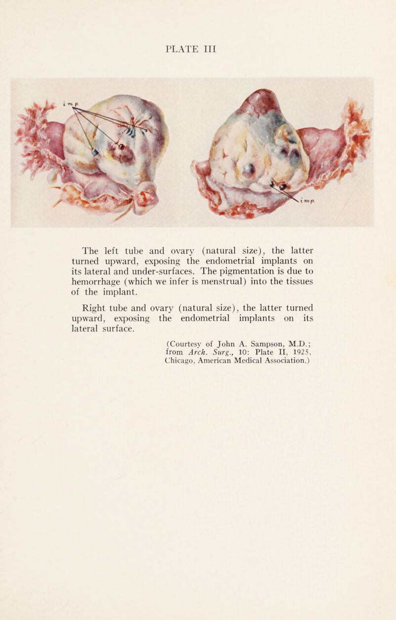 The left tube and ovary (natural size), the latter turned upward, exposing the endometrial implants on its lateral and under-surfaces. The pigmentation is due to hemorrhage (which we infer is menstrual) into the tissues of the implant. Right tube and ovary (natural size), the latter turned upward, exposing the endometrial implants on its lateral surface. (Courtesy of John A. Sampson, M.D.; from Arch. Surg., 10: Plate II, 1925, Chicago, American Medical Association.)