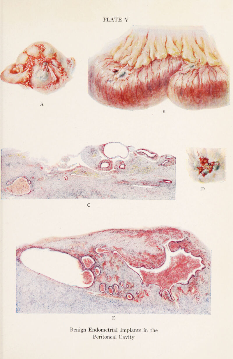 , v4 _ -: E Benign Endometrial Implants in the Peritoneal Cavity