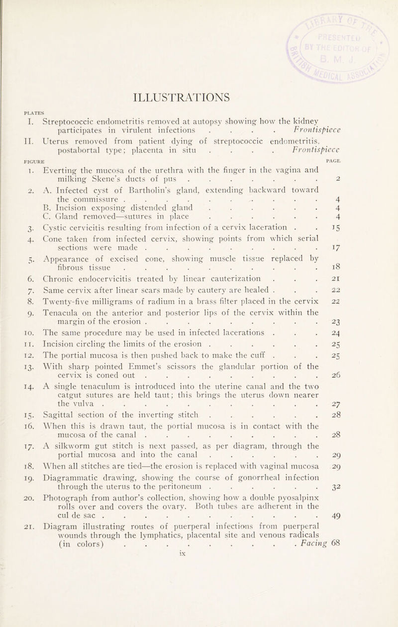 PLATES I. Streptococcic endometritis removed at autopsy showing how the kidney participates in virulent infections .... Frontispiece II. Uterus removed from patient dying of streptococcic endometritis, postabortal type; placenta in situ .... Frontispiece FIGURE PAGE 1. Everting the mucosa of the urethra with the finger in the vagina and milking Skene’s ducts of pus ....... 2 2. A. Infected cyst of Bartholin’s gland, extending backward toward the commissure .......... 4 B. Incision exposing distended gland ...... 4 C. Gland removed—sutures in place ...... 4 3. Cystic cervicitis resulting from infection of a cervix laceration . . 15 4. Cone taken from infected cervix, showing points from which serial sections were made ......... 17 5. Appearance of excised cone, showing muscle tissue replaced by fibrous tissue .......... 18 6. Chronic endocervicitis treated by linear cauterization . . .21 7. Same cervix after linear scars made by cautery are healed ... 22 8. Twenty-five milligrams of radium in a brass filter placed in the cervix 22 9. Tenacula on the anterior and posterior lips of the cervix within the margin of the erosion ......... 23 10. The same procedure may be used in infected lacerations ... 24 11. Incision circling the limits of the erosion ...... 25 12. The portial mucosa is then pushed back to make the cuff ... 25 13. With sharp pointed Emmet’s scissors the glandular portion of the cervix is coned out ......... 26 14. A single tenaculum is introduced into the uterine canal and the two catgut sutures are held taut; this brings the uterus down nearer the vulva ........... 27 15. Sagittal section of the inverting stitch ...... 28 16. When this is drawn taut, the portial mucosa is in contact with the mucosa of the canal ......... 28 17. A silkworm gut stitch is next passed, as per diagram, through the portial mucosa and into the canal ...... 29 18. When all stitches are tied—the erosion is replaced with vaginal mucosa 29 19. Diagrammatic drawing, showing the course of gonorrheal infection through the uterus to the peritoneum ...... 32 20. Photograph from author’s collection, showing how a double pyosalpinx rolls over and covers the ovary. Both tubes are adherent in the cul de sac ........... 49 21. Diagram illustrating routes of puerperal infections from puerperal wounds through the lymphatics, placental site and venous radicals (in colors) ......... Facing 68