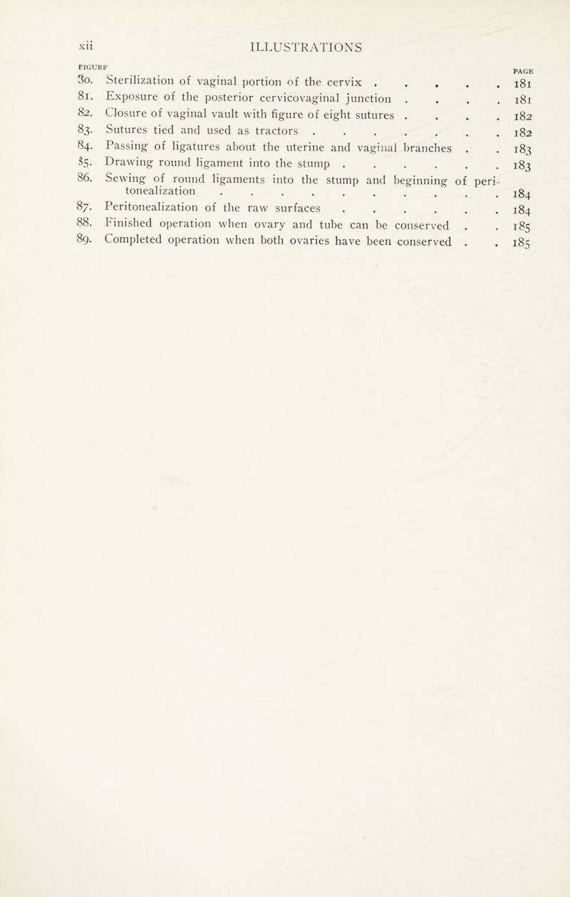 riGURF ... . . ^ge 3o. Sterilization of vaginal portion of the cervix ..... 181 81. Exposure of the posterior cervicovaginal junction .... 181 82. Closure of vaginal vault with figure of eight sutures .... 182 83. Sutures tied and used as tractors . .1S2 84. Passing of ligatures about the uterine and vaginal branches . . 183 &5- Drawing round ligament into the stump ...... 183 86. Sewing of round ligaments into the stump and beginning of peri- tonealization . . . . . . . . . jg^ 87. Peritonealization of the raw surfaces ...... 184 88. Finished operation when ovary and tube can be conserved . -185 89. Completed operation when both ovaries have been conserved . . 185